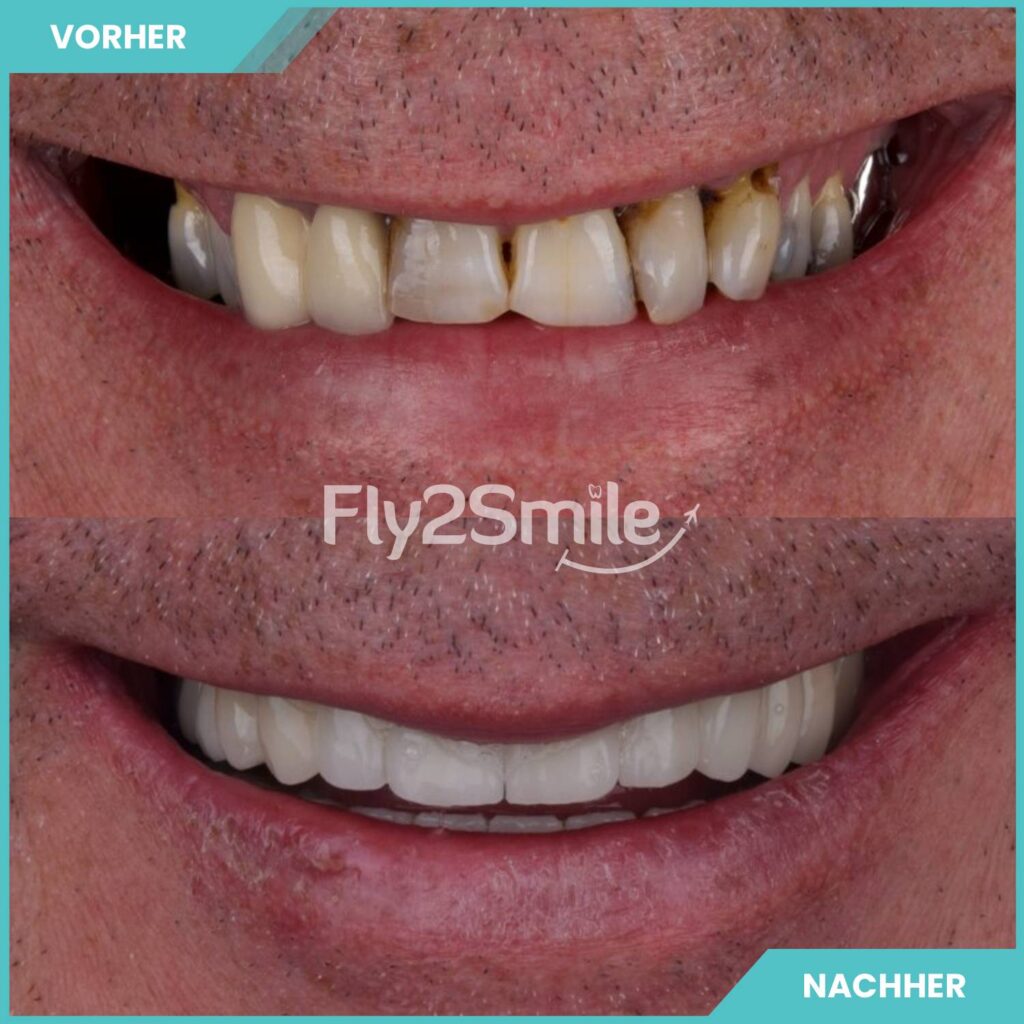 Veneers Türkei Vorher-Nachher Resultat mit ästhetischer Zahnkorrektur und strahlendem Lächeln
