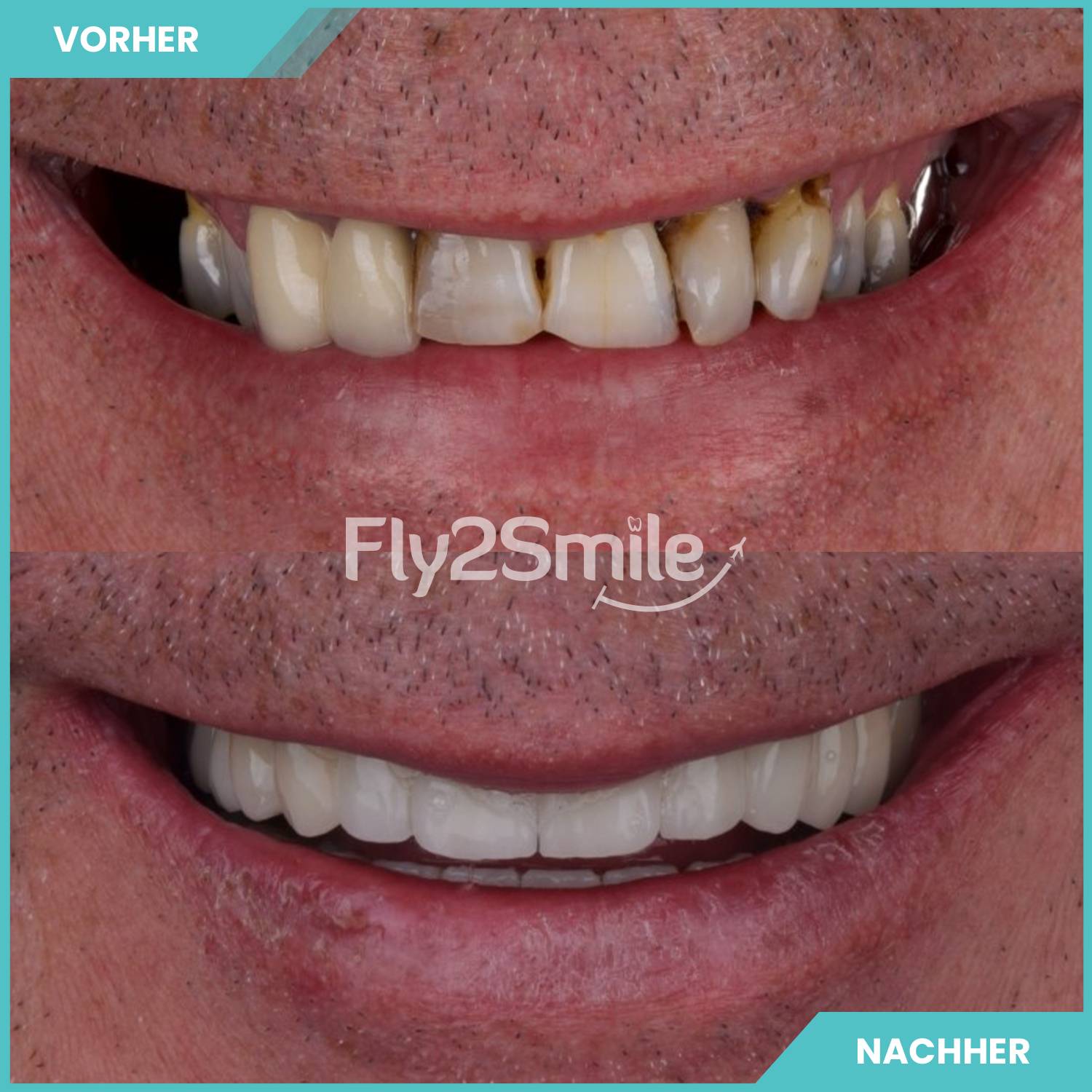 Veneers Türkei Vorher-Nachher Resultat mit ästhetischer Zahnkorrektur und strahlendem Lächeln