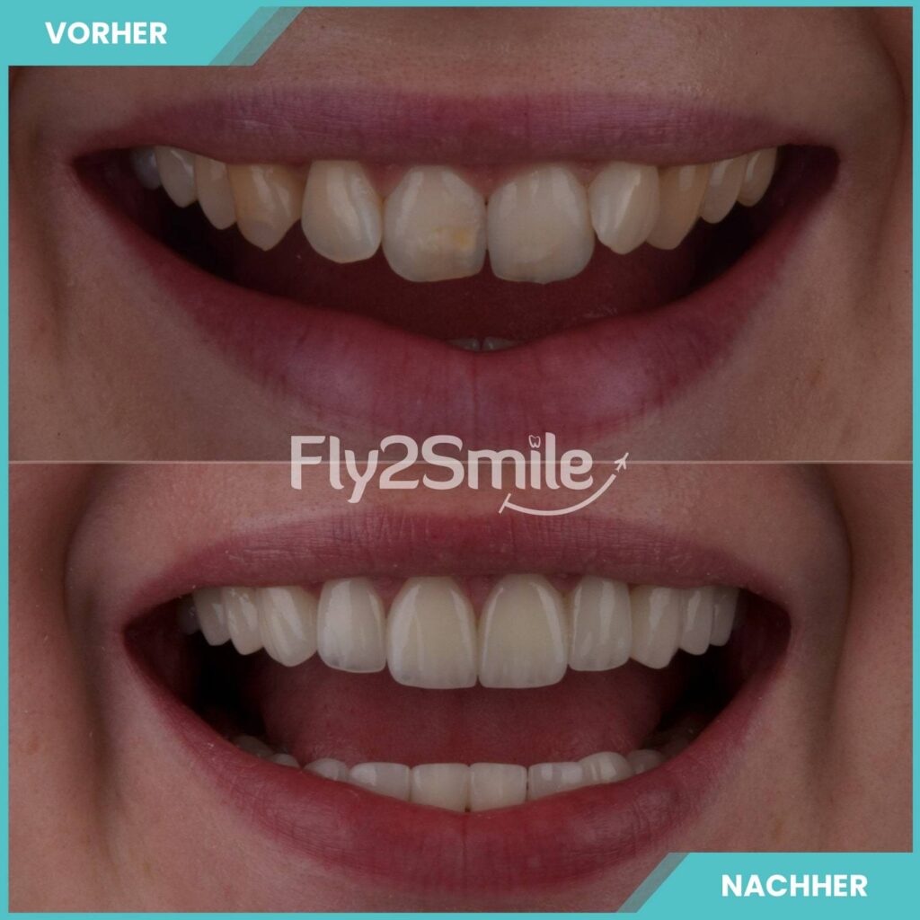 Veneers Türkei Vorher-Nachher Ergebnis mit strahlendem Lächeln und natürlich wirkenden Zähnen