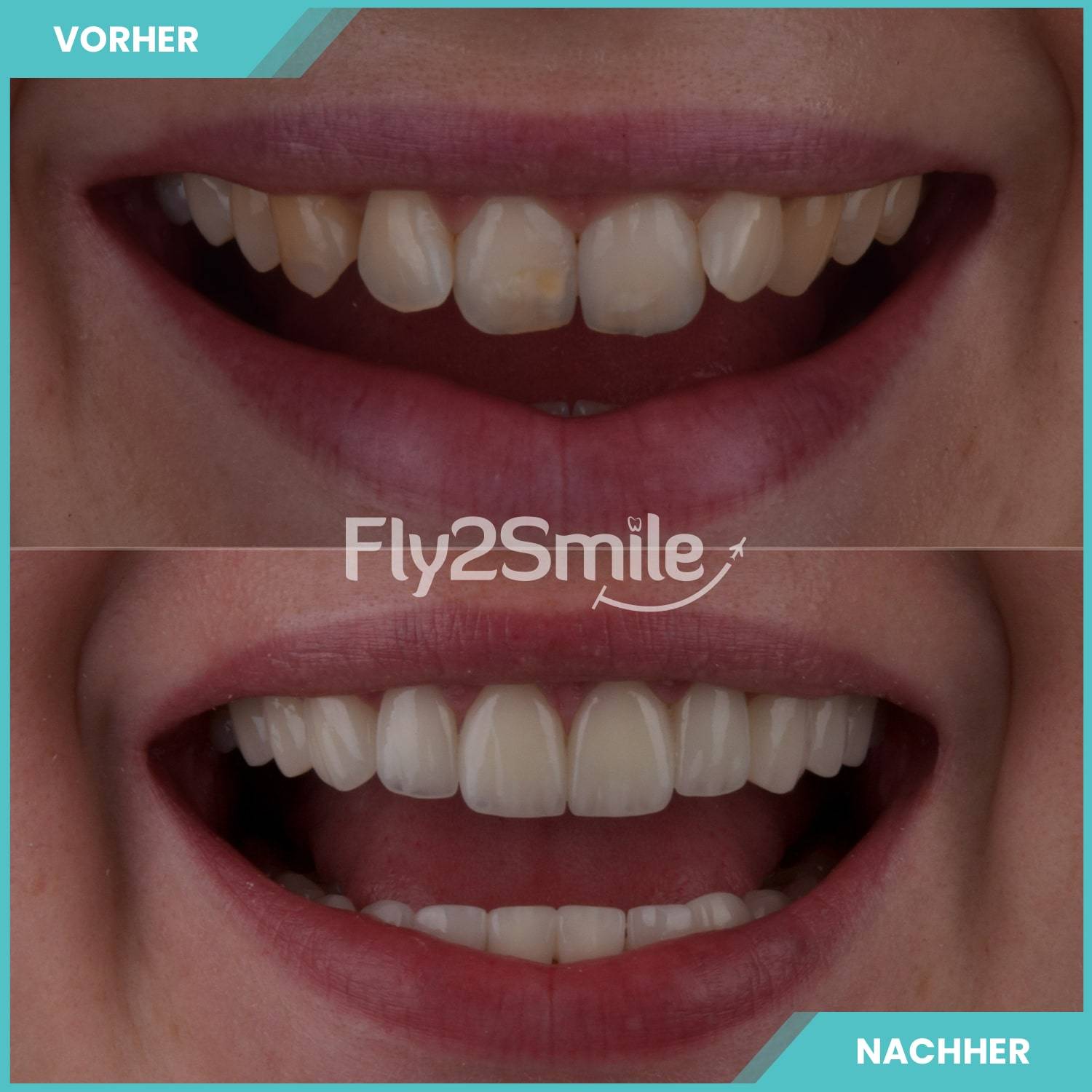 Veneers Türkei Vorher-Nachher Ergebnis mit strahlendem Lächeln und natürlich wirkenden Zähnen