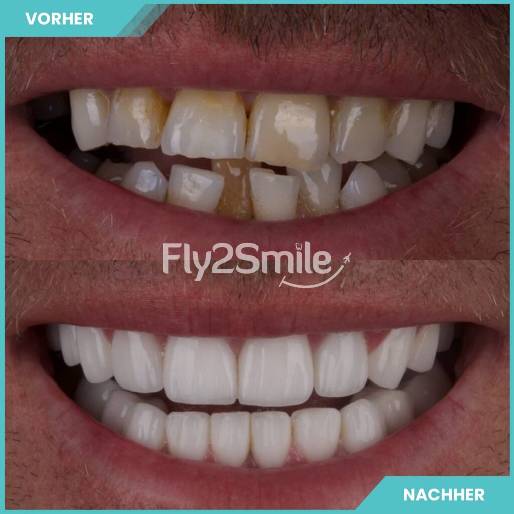 Veneers Vorher-Nachher Ergebnis für ein strahlendes, harmonisches und natürliches Lächeln