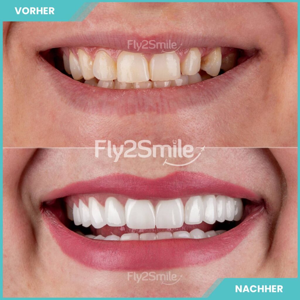 Veneers Vorher-Nachher Ergebnis mit natürlich wirkenden Zähnen und ästhetischem Lächeln