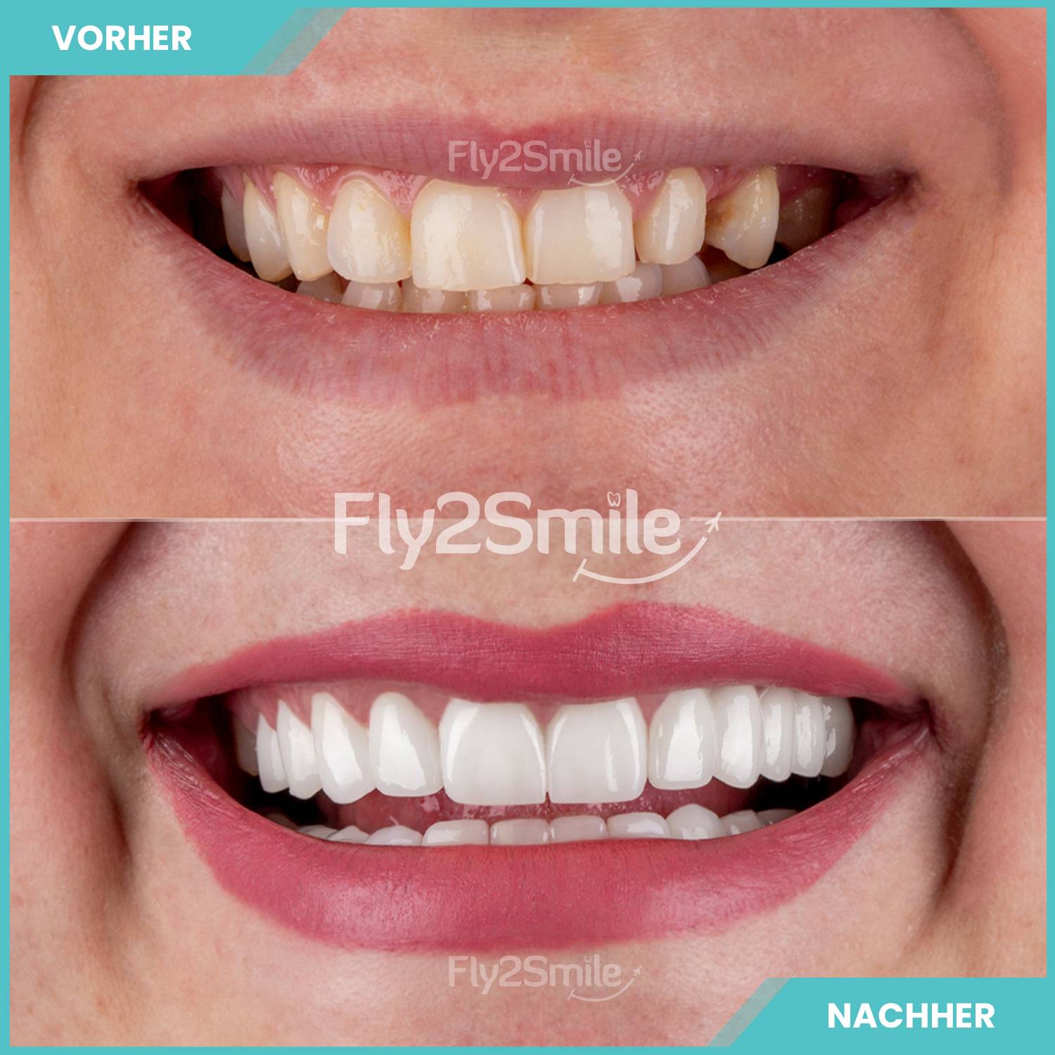 Veneers Vorher-Nachher Ergebnis mit natürlich wirkenden Zähnen und ästhetischem Lächeln