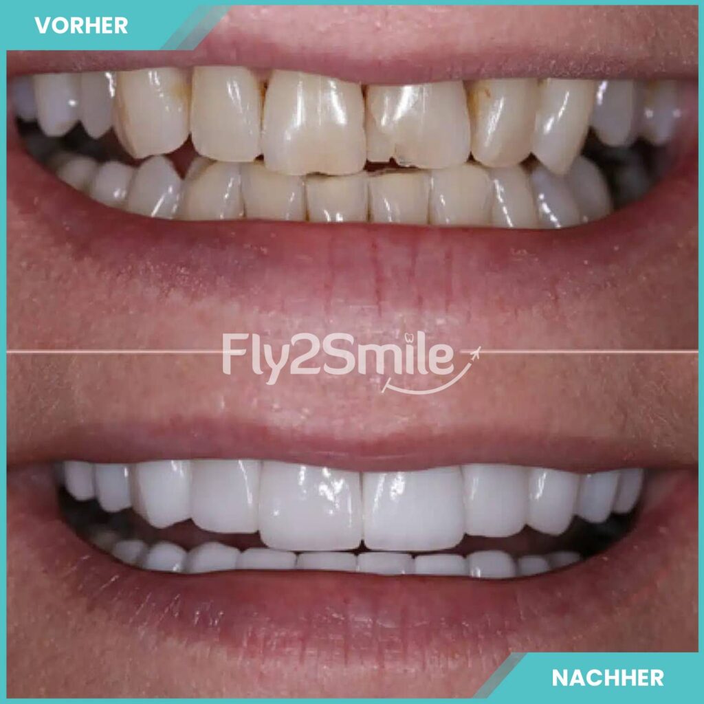 Veneers Türkei Vorher-Nachher Ergebnis mit natürlich schönen Zähnen und strahlendem Lächeln