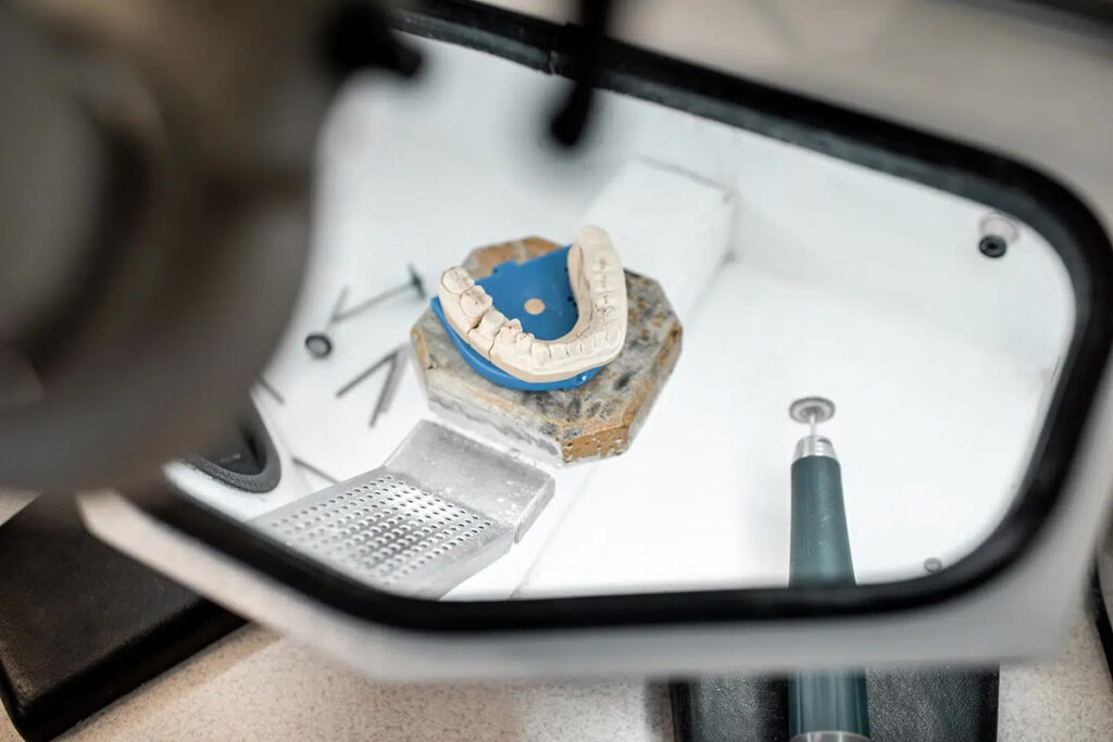 Erfahrungen beim Zähne abschleifen für Veneers, Kronen oder ästhetische Zahnbehandlungen