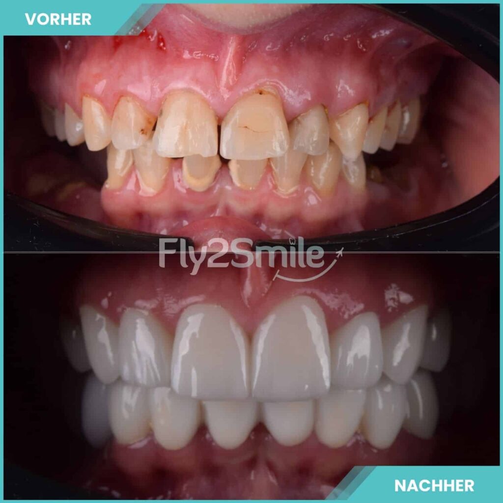 Zahnimplantat Türkei Vorher-Nachher Ergebnis mit festem und natürlich wirkendem Zahnersatz