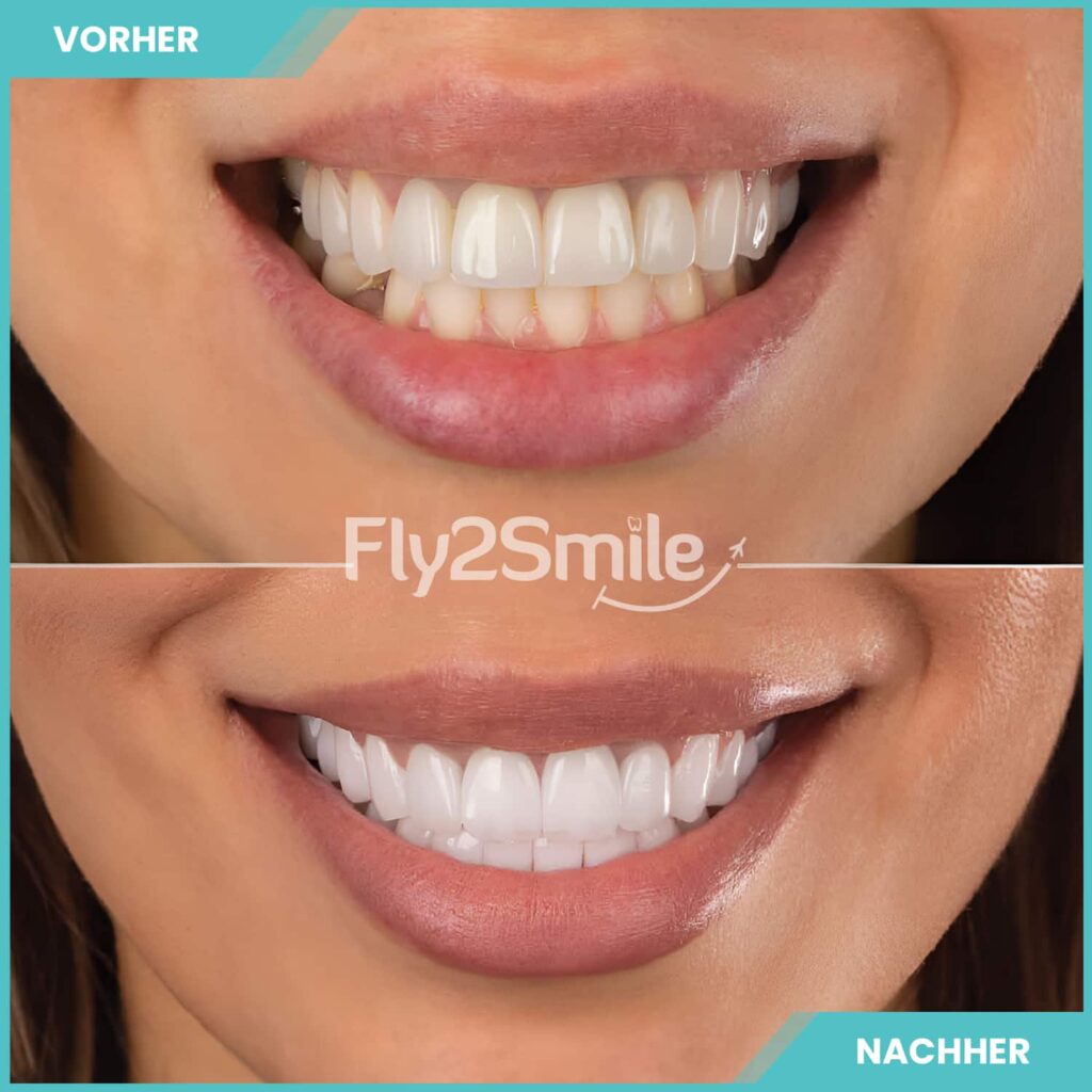 Zahnimplantat und Zahnreinigung Vorher-Nachher Ergebnis mit Fly2Smile für gesunde, gepflegte und natürlich wirkende Zähne
