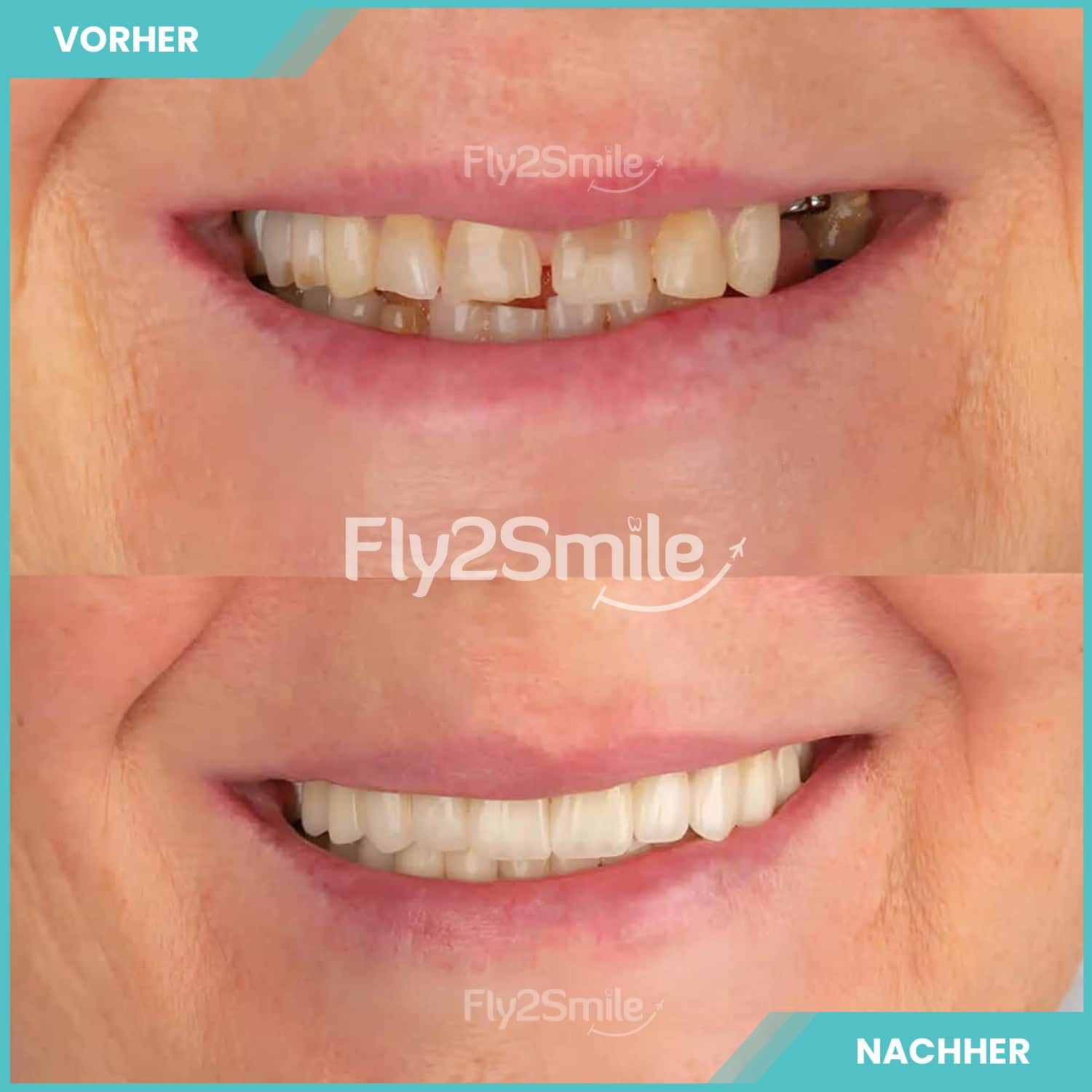 Zahnimplantat Vorher-Nachher Ergebnis mit Fly2Smile für festen Zahnersatz und ein natürlich wirkendes Lächeln