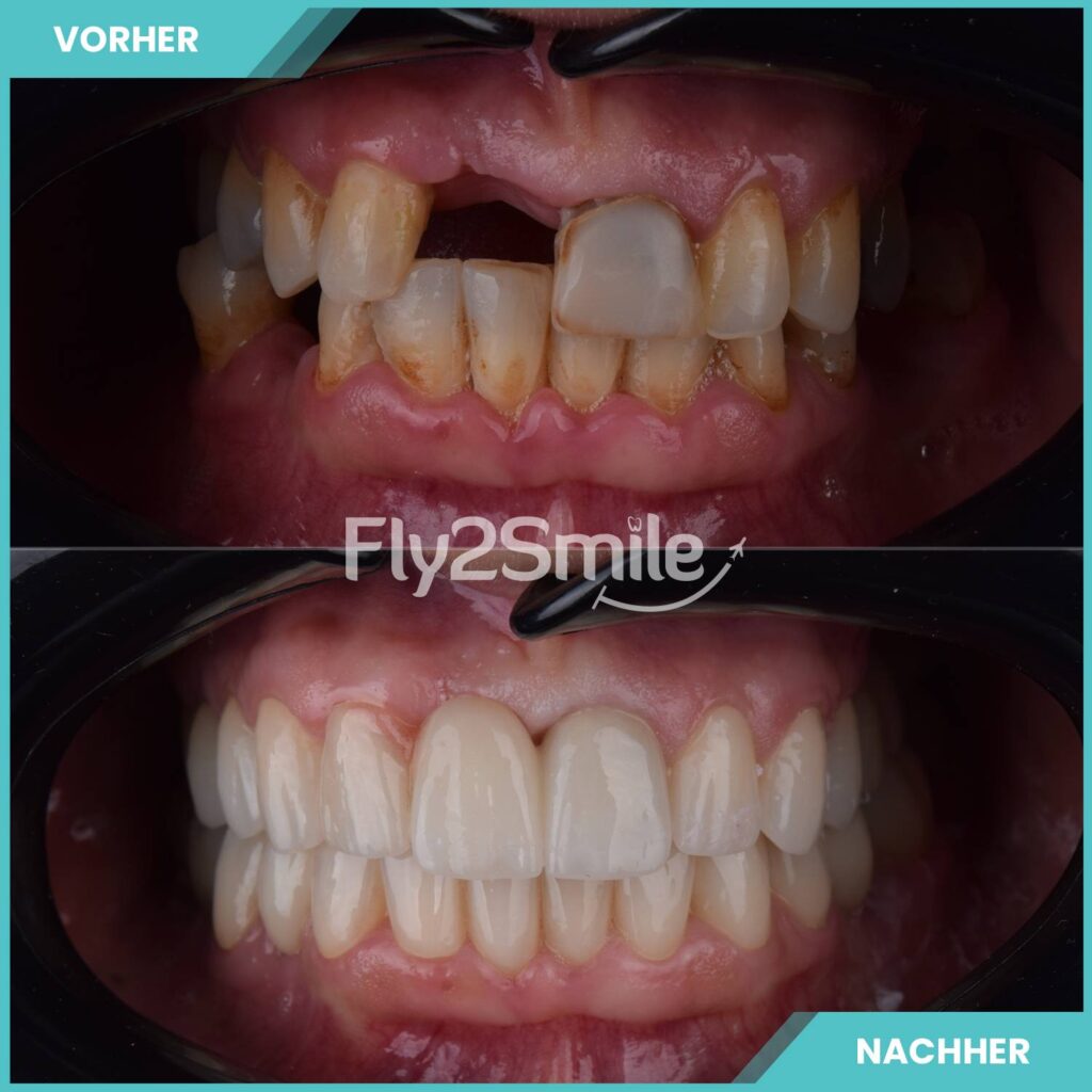 Zahnimplantate mit Fly2Smile Vorher-Nachher Ergebnis für festen und natürlich wirkenden Zahnersatz