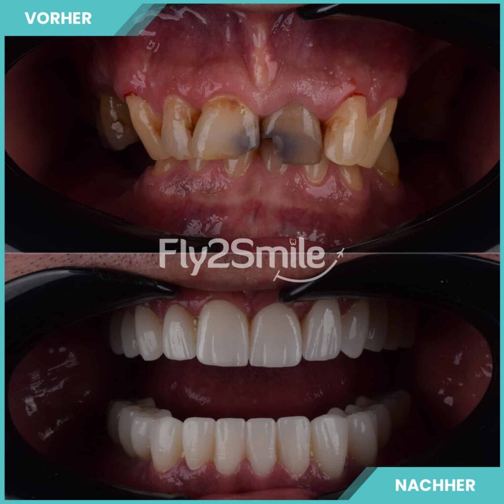 Zahnimplantate Türkei Vorher-Nachher Ergebnis mit festem, ästhetischem und natürlich wirkendem Zahnersatz