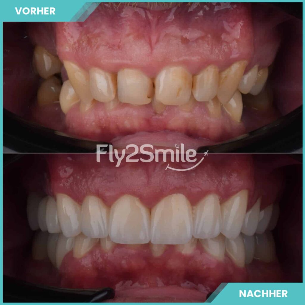 Zahnimplantate Vorher-Nachher Ergebnis mit Fly2Smile für festen und natürlich wirkenden Zahnersatz