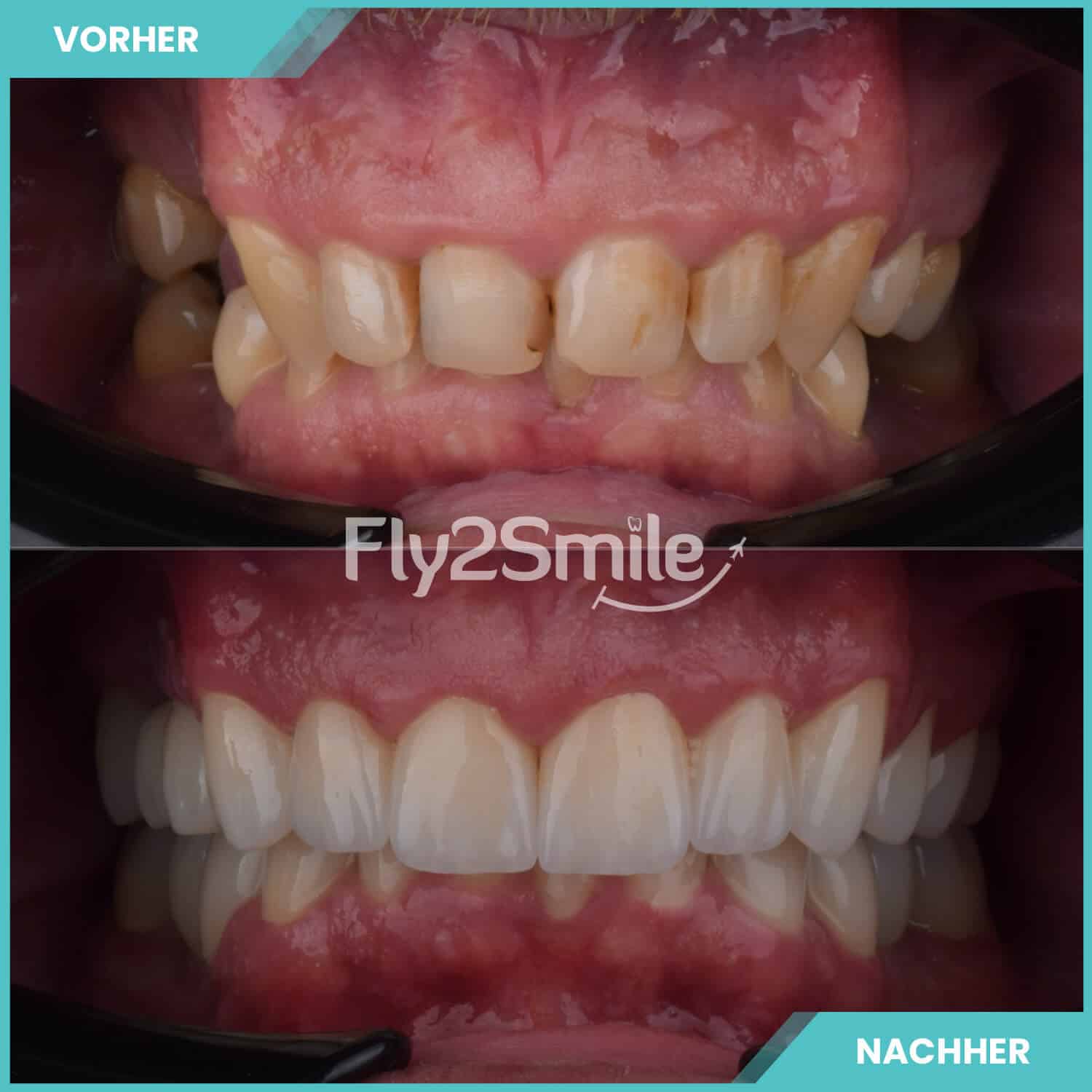 Zahnimplantate Vorher-Nachher Ergebnis mit Fly2Smile für festen und natürlich wirkenden Zahnersatz