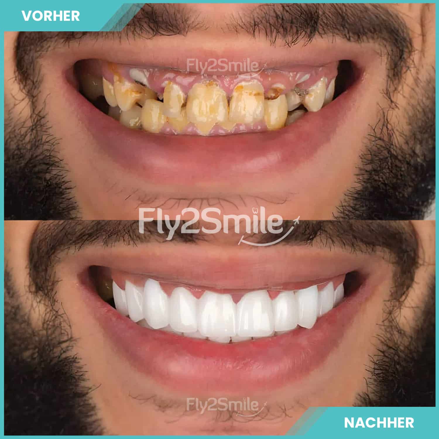 Zahnimplantate Vorher-Nachher Restaurierung mit Fly2Smile für festen Zahnersatz und ein natürliches Lächeln
