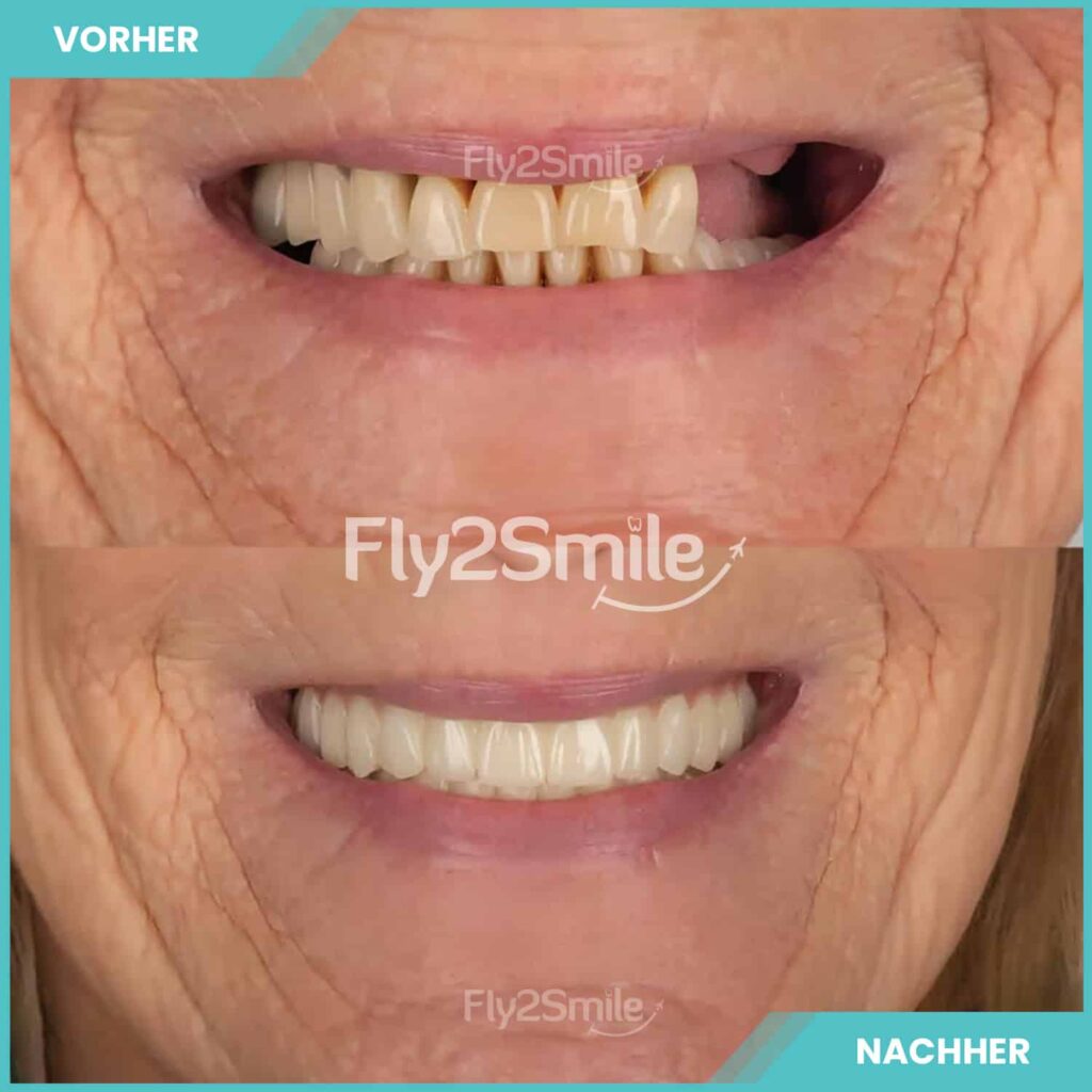 Zahnimplantate Vorher-Nachher Ergebnis mit Fly2Smile für festen Zahnersatz und ein natürlich wirkendes Lächeln