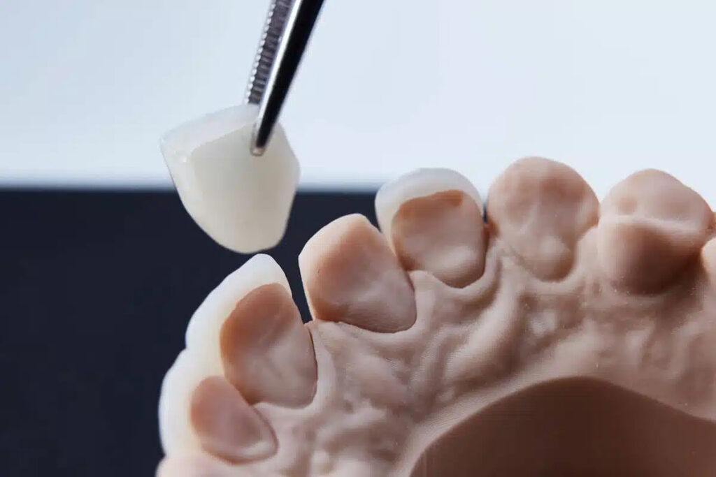 Emax Veneers für hochwertige Keramikveneers und ein natürlich schönes Lächeln