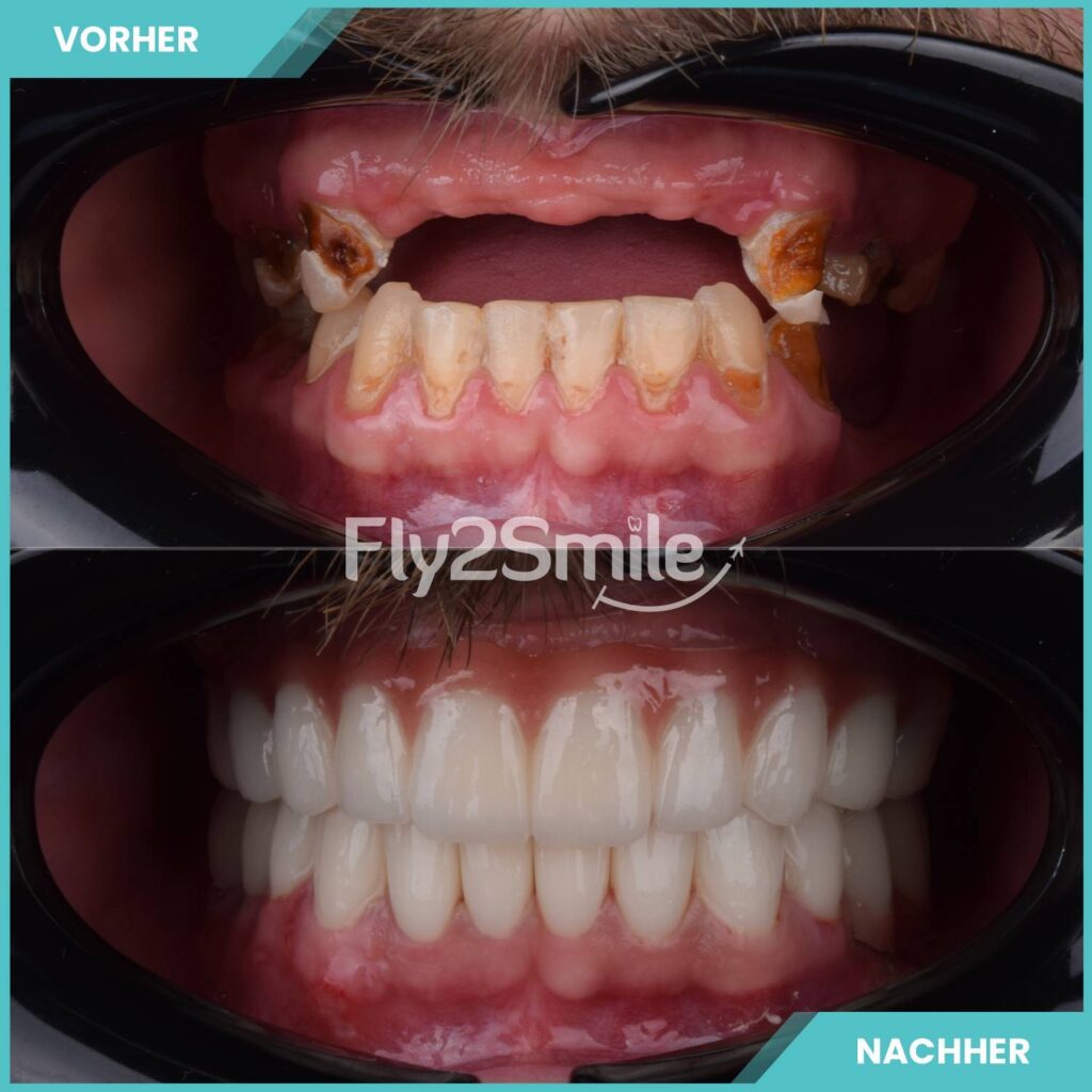 Komplette Zahnimplantate mit Fly2Smile für festen, natürlichen und langlebigen Zahnersatz