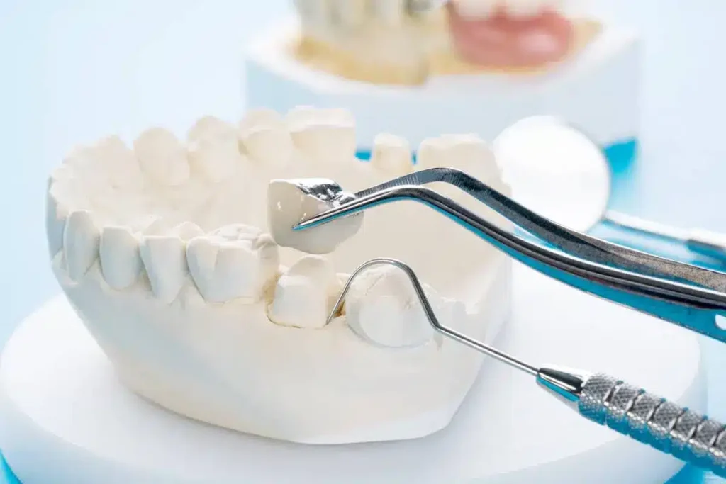 Überkronen eines Zahns mit Zahnkrone für Schutz, Stabilität und natürliche Zahnästhetik
