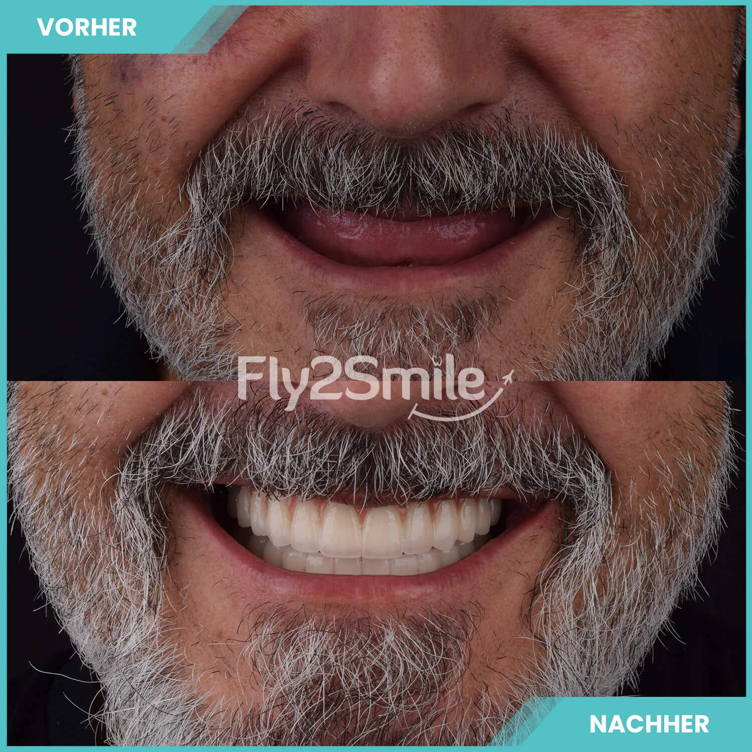All-on-4 Vorher-Nachher Ergebnis mit festen Zähnen von Fly2Smile