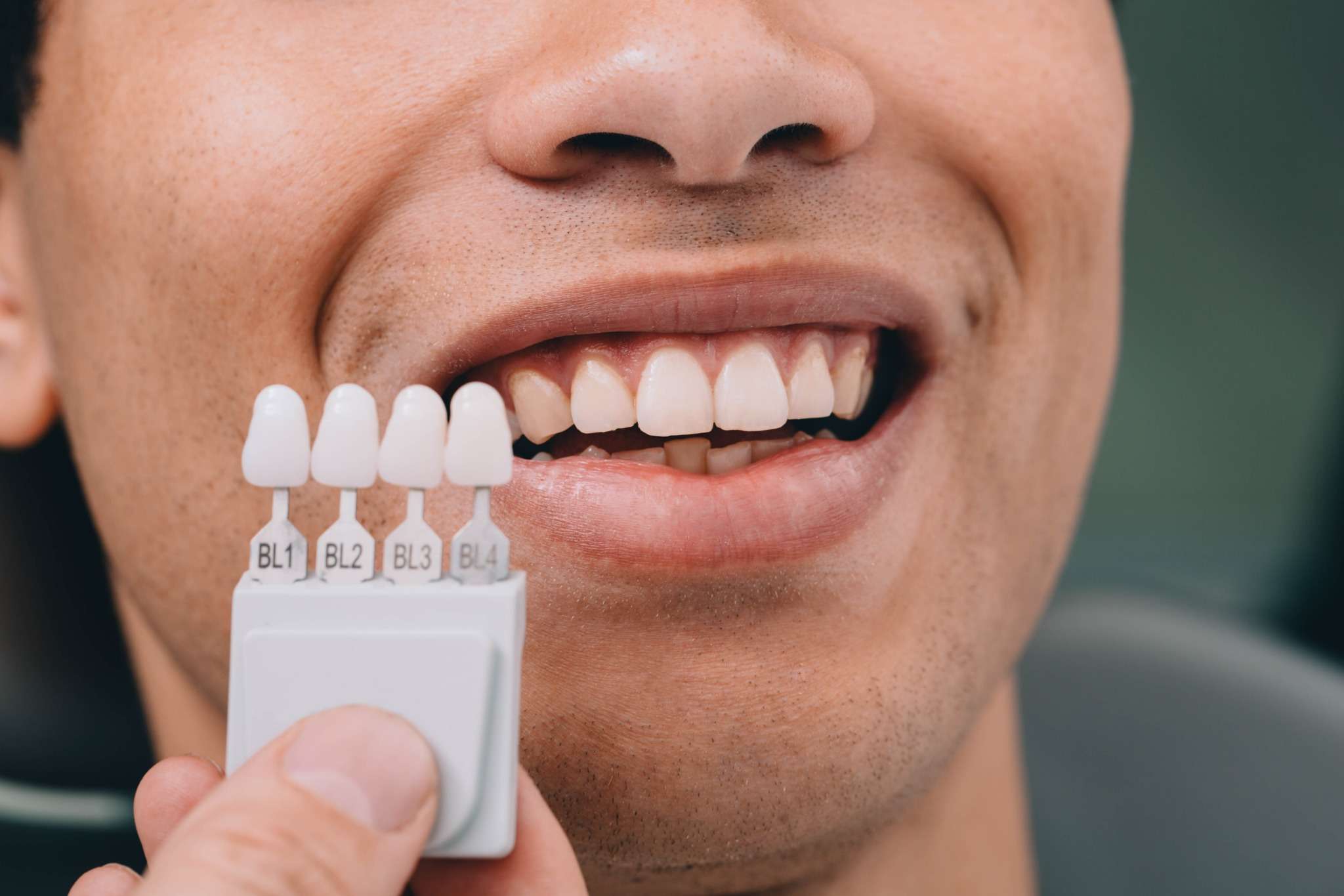 Komposit Veneers – Kosten, Ablauf und Vergleich