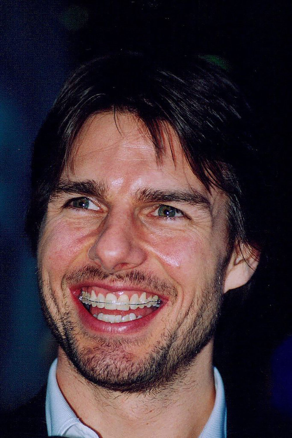 Tom Cruise mit Zahnspange während seiner kieferorthopädischen Behandlung
