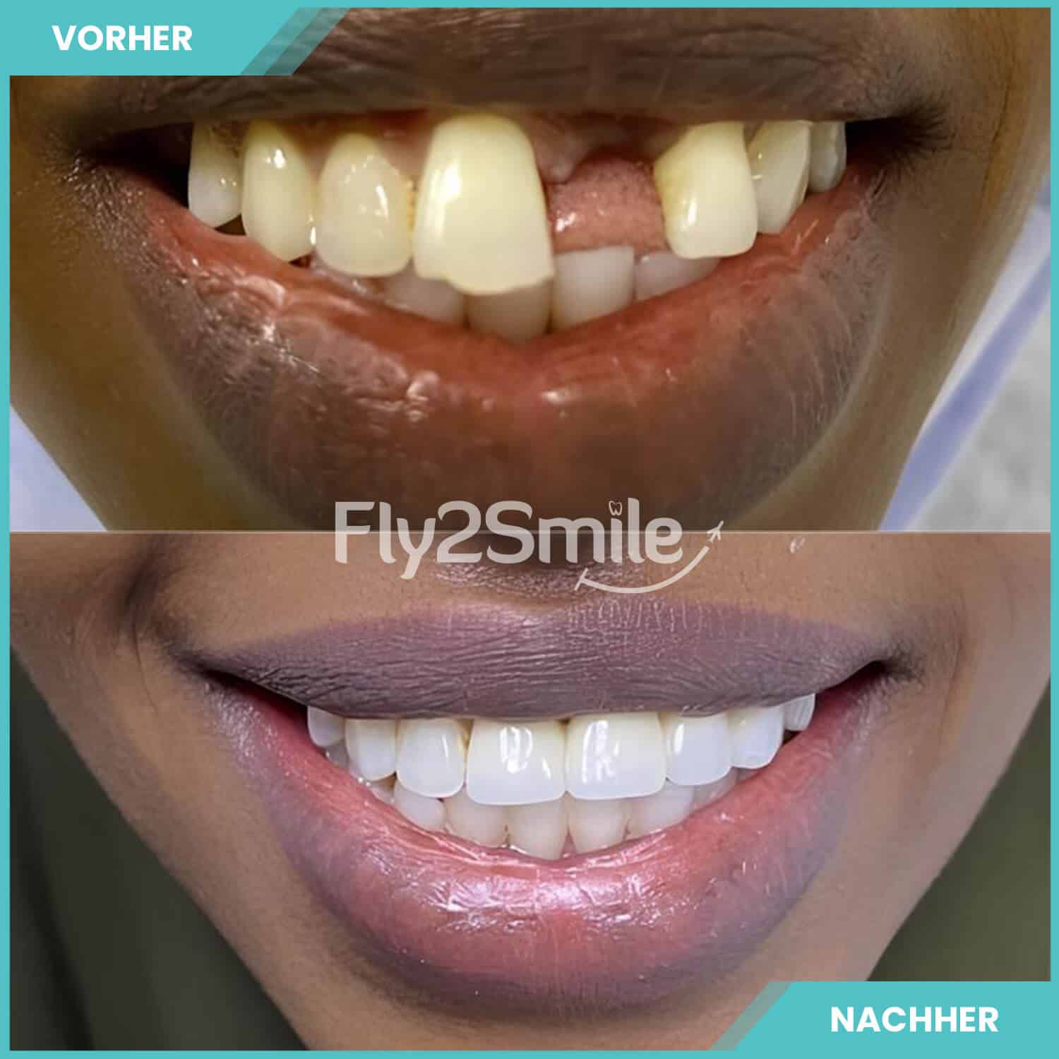 Erfolgreiches Zahnimplantat Türkei Ergebnis mit Fly2Smile