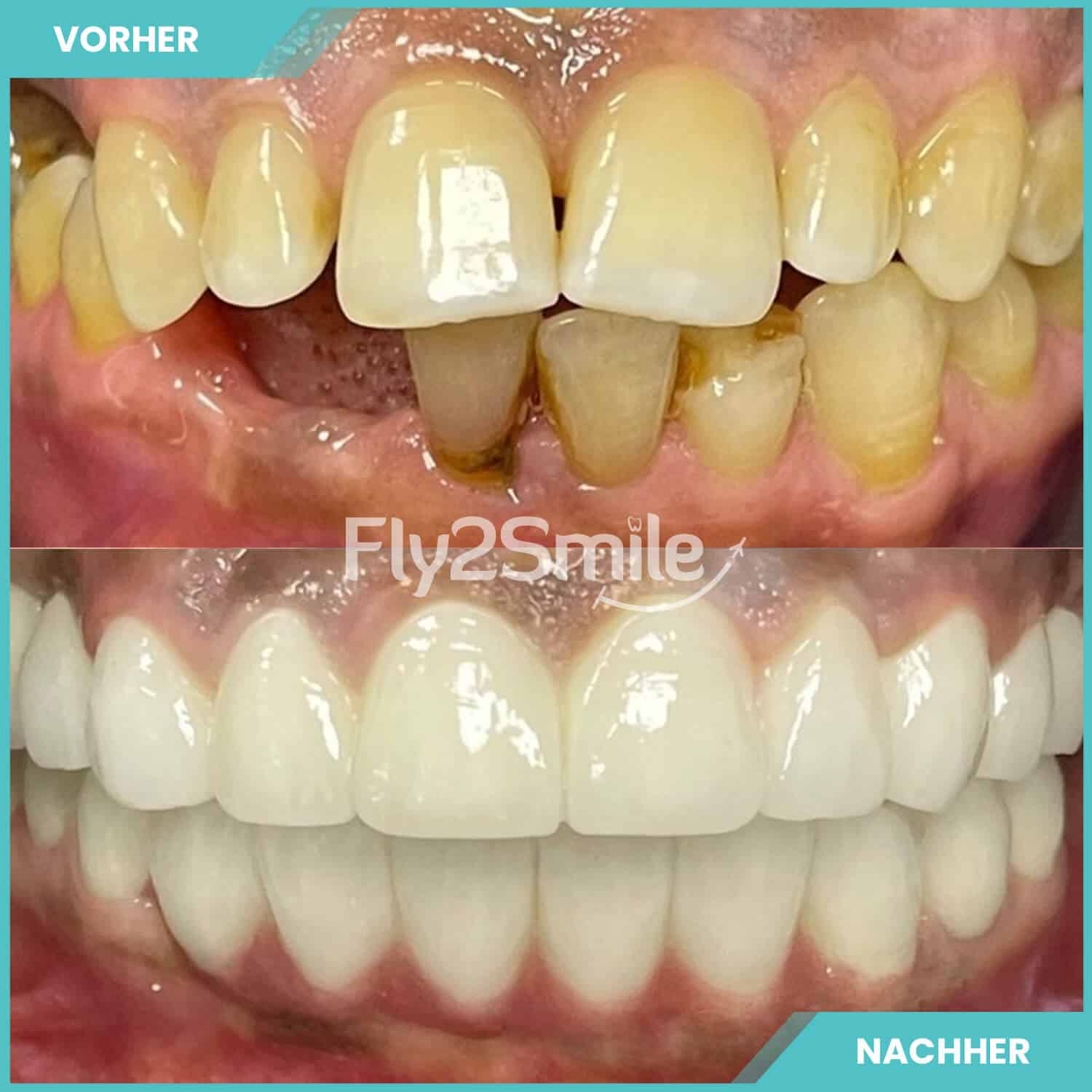 Natürliches Zahnimplantat Ergebnis in der Türkei mit Fly2Smile