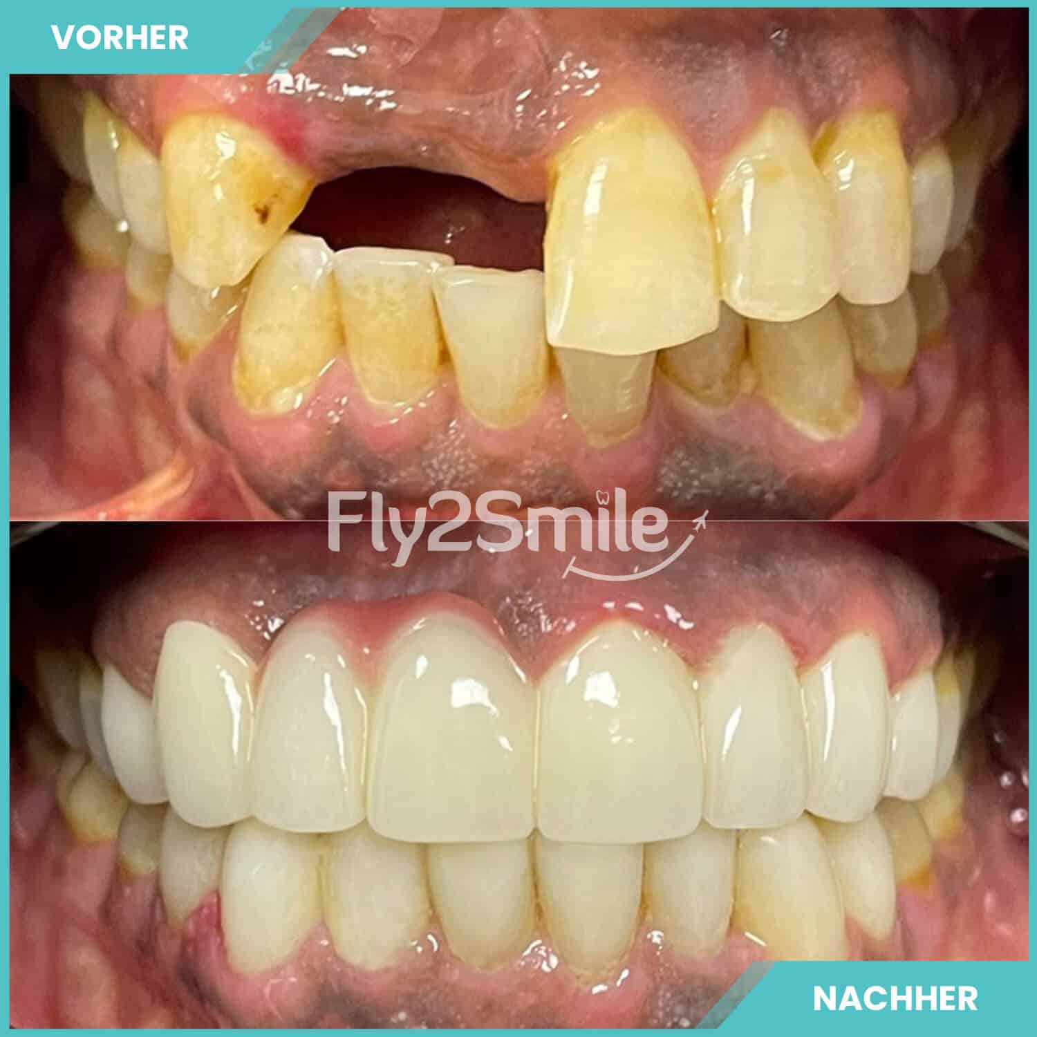 Ästhetisches Zahnimplantat Türkei Ergebnis nach der Behandlung mit Fly2Smile
