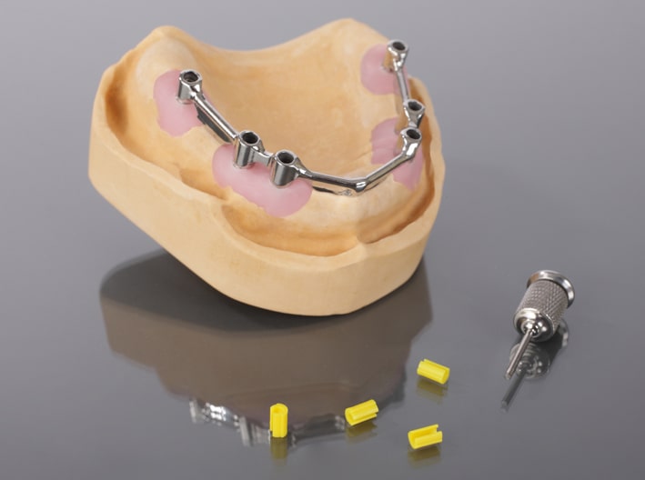 Werkzeuge und Vorbereitung für die Anpassung einer implantatgetragenen Stegprothese