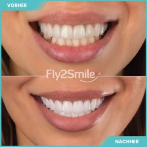 Zahnimplantat-und-Zahnreinigung-vorher-nachher-mit-Fly2Smile