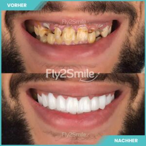 Zahnimplantate-vorher-nachher-Restaurierung-mit-Fly2Smile