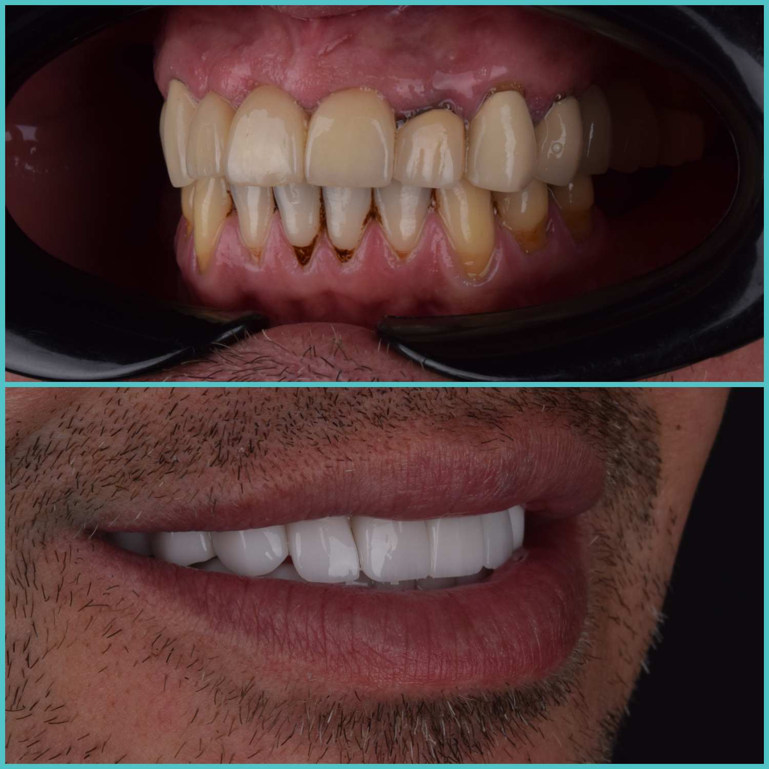 komplette zahnimplantate mit fly2smile