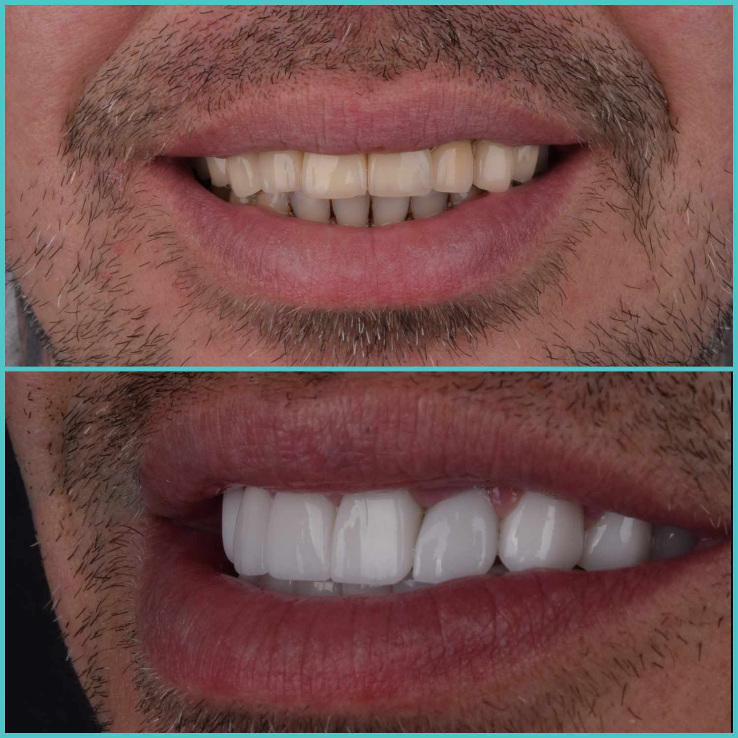 komplette zahnimplantate mit fly2smile