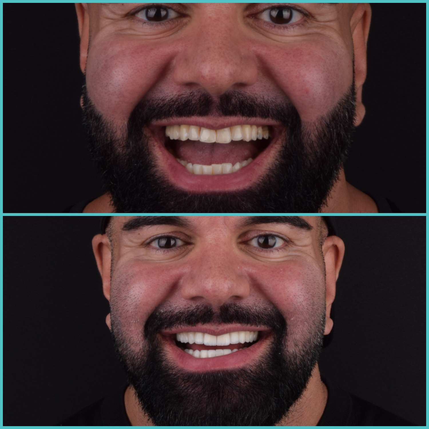 komplette zahnimplantate mit fly2smile