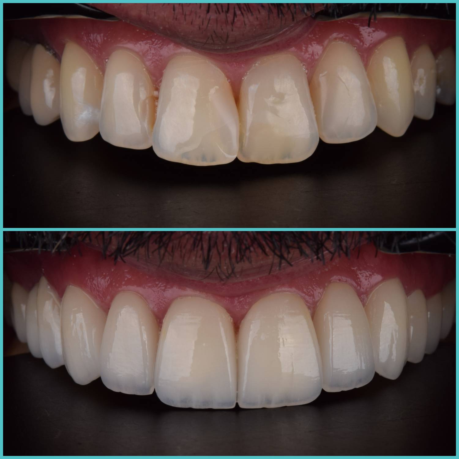 komplette zahnimplantate mit fly2smile