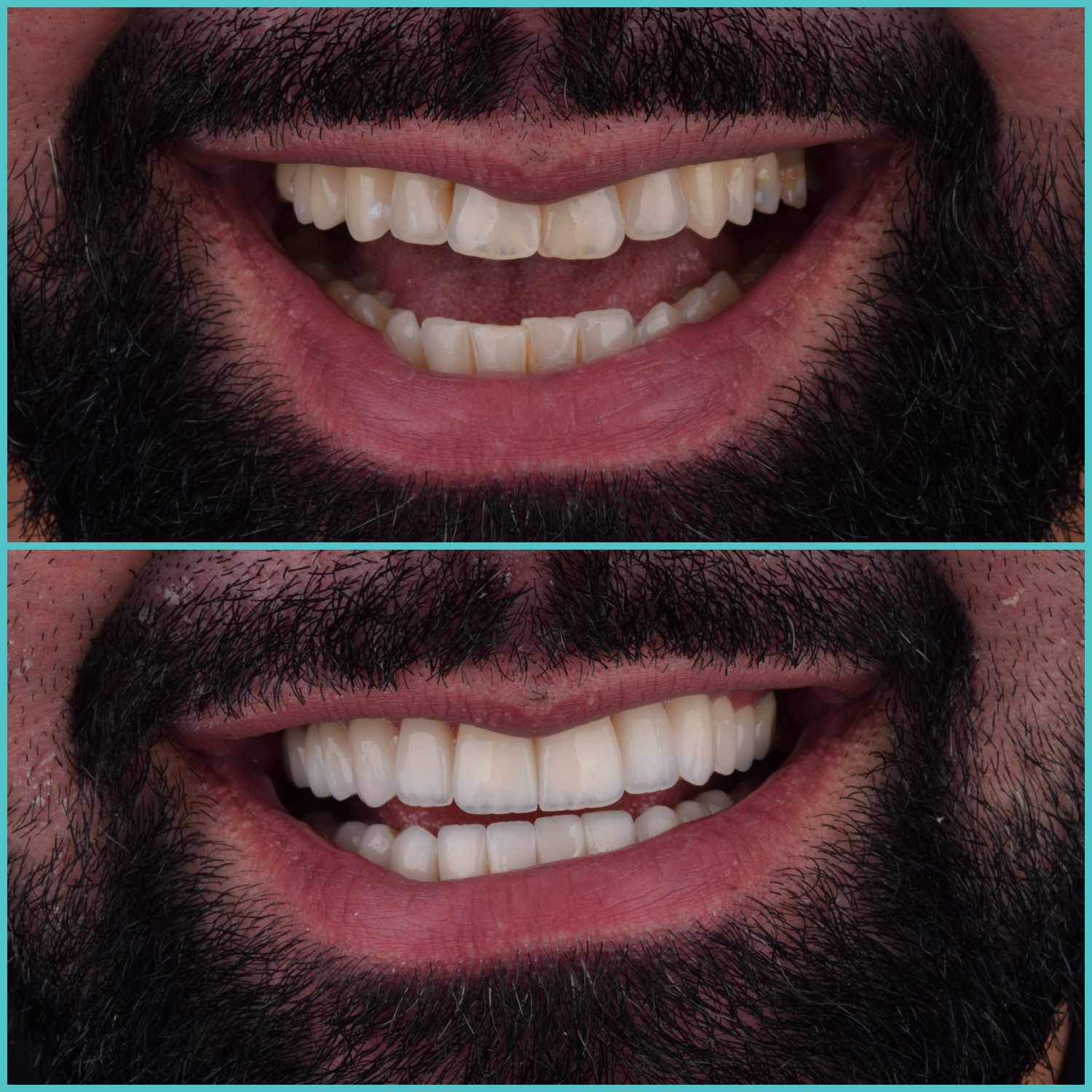 komplette zahnimplantate mit fly2smile