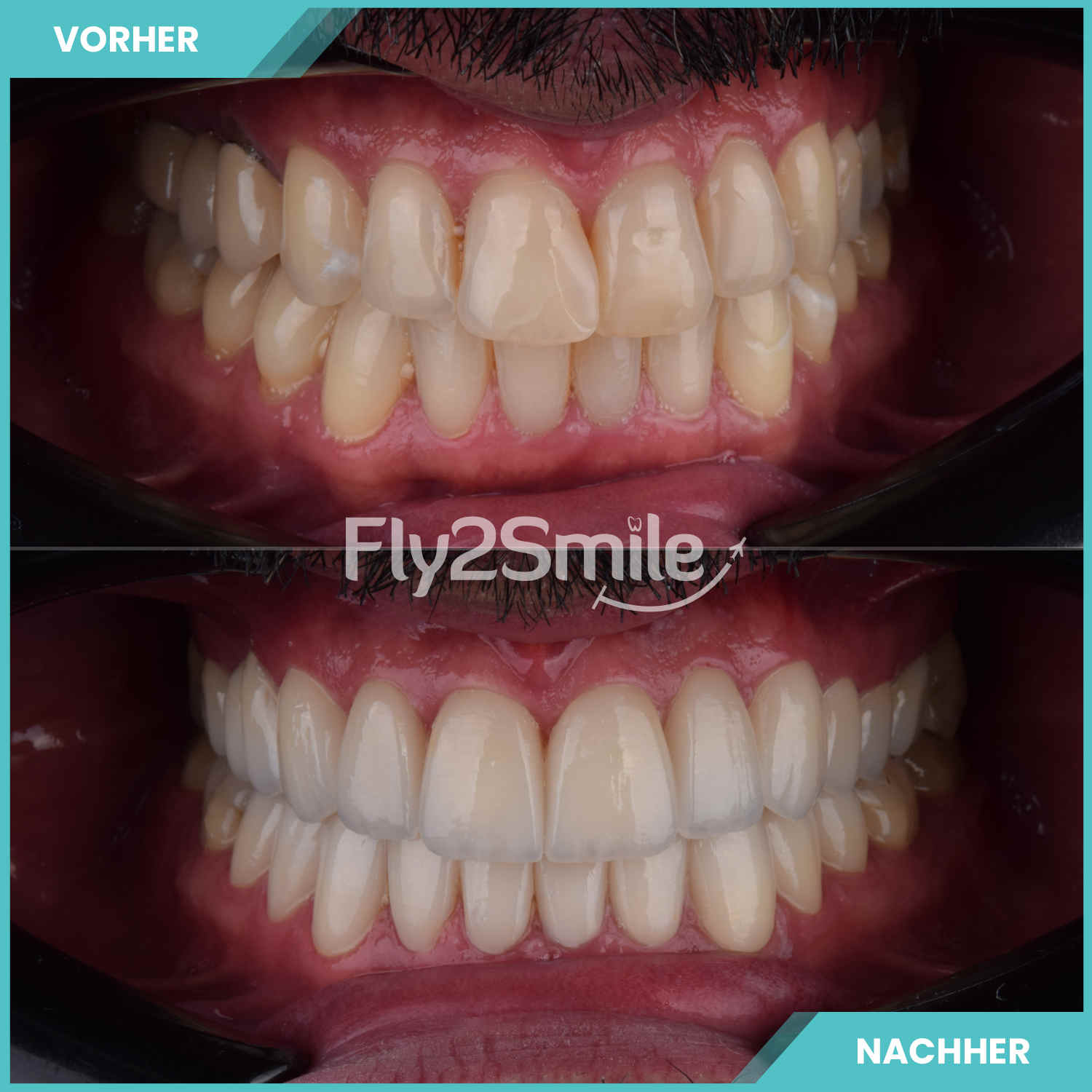 komplette zahnimplantate mit fly2smile