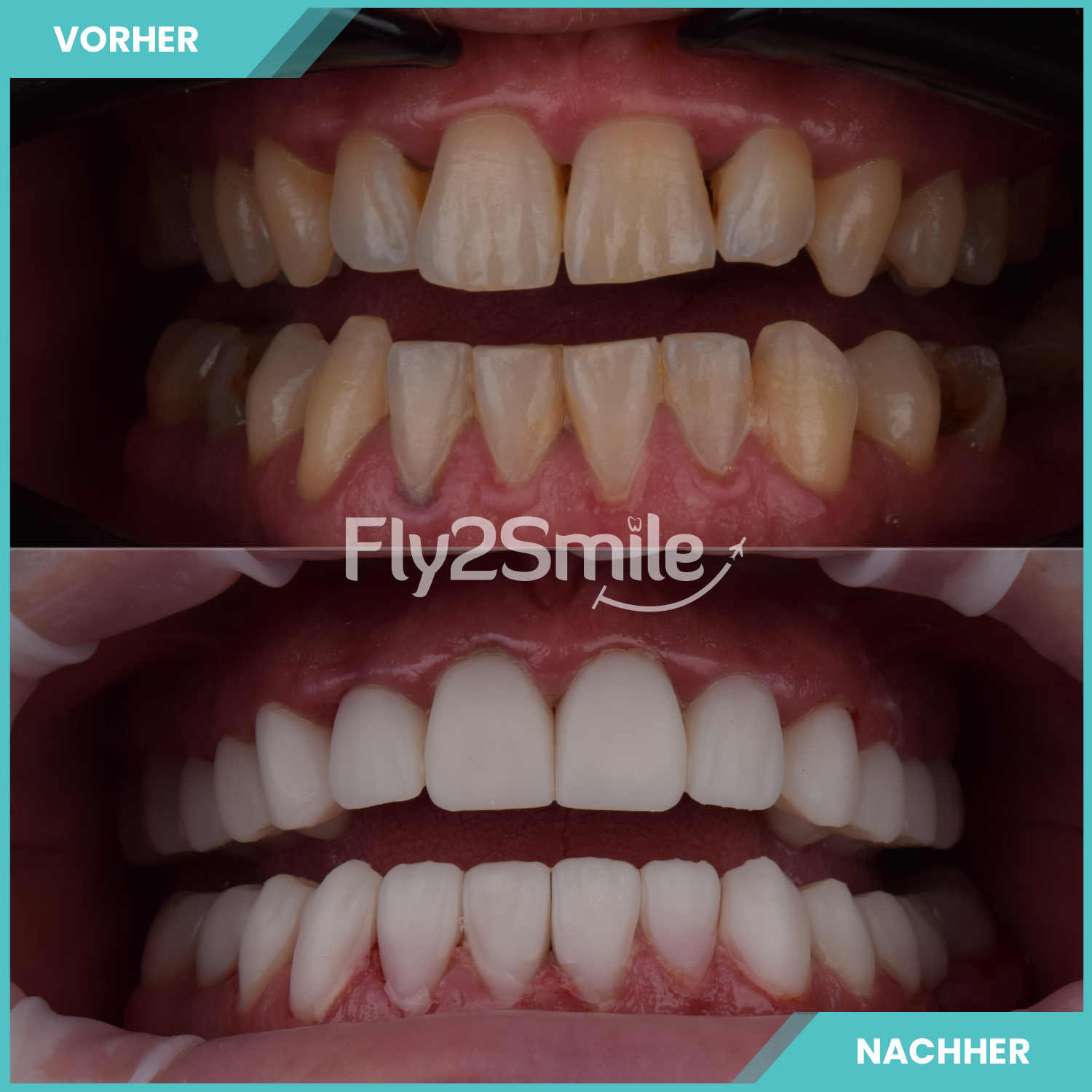 komplette zahnimplantate mit fly2smile