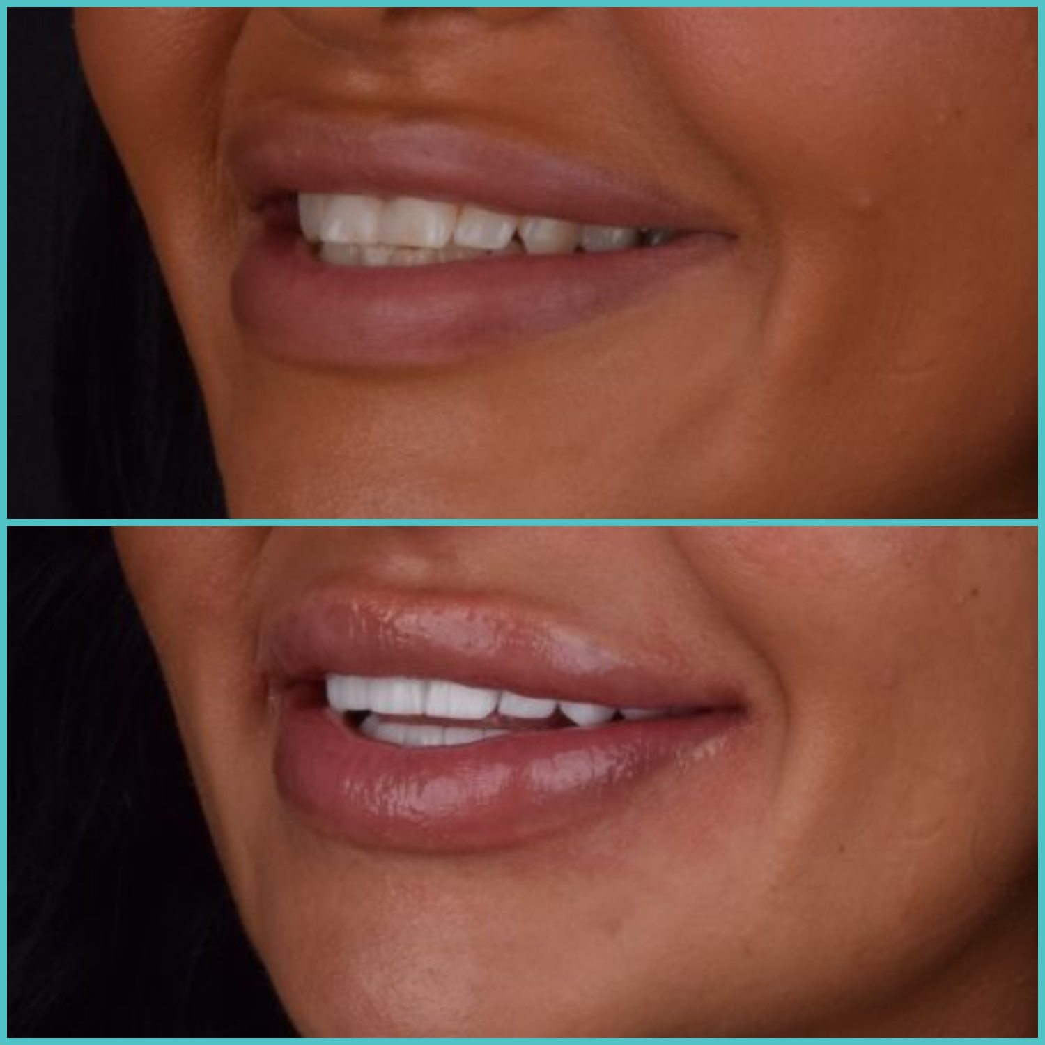 komplette zahnimplantate mit fly2smile