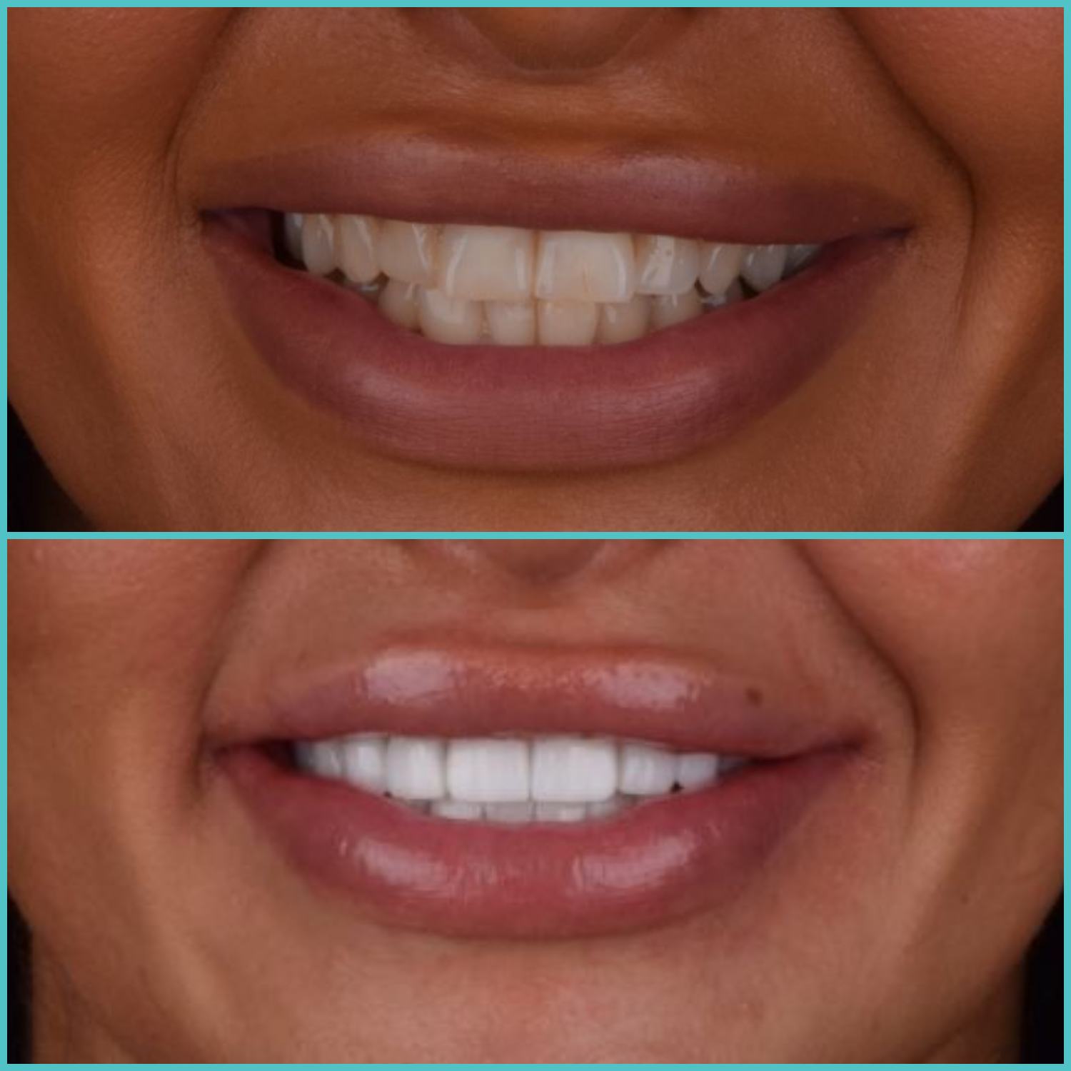 komplette zahnimplantate mit fly2smile