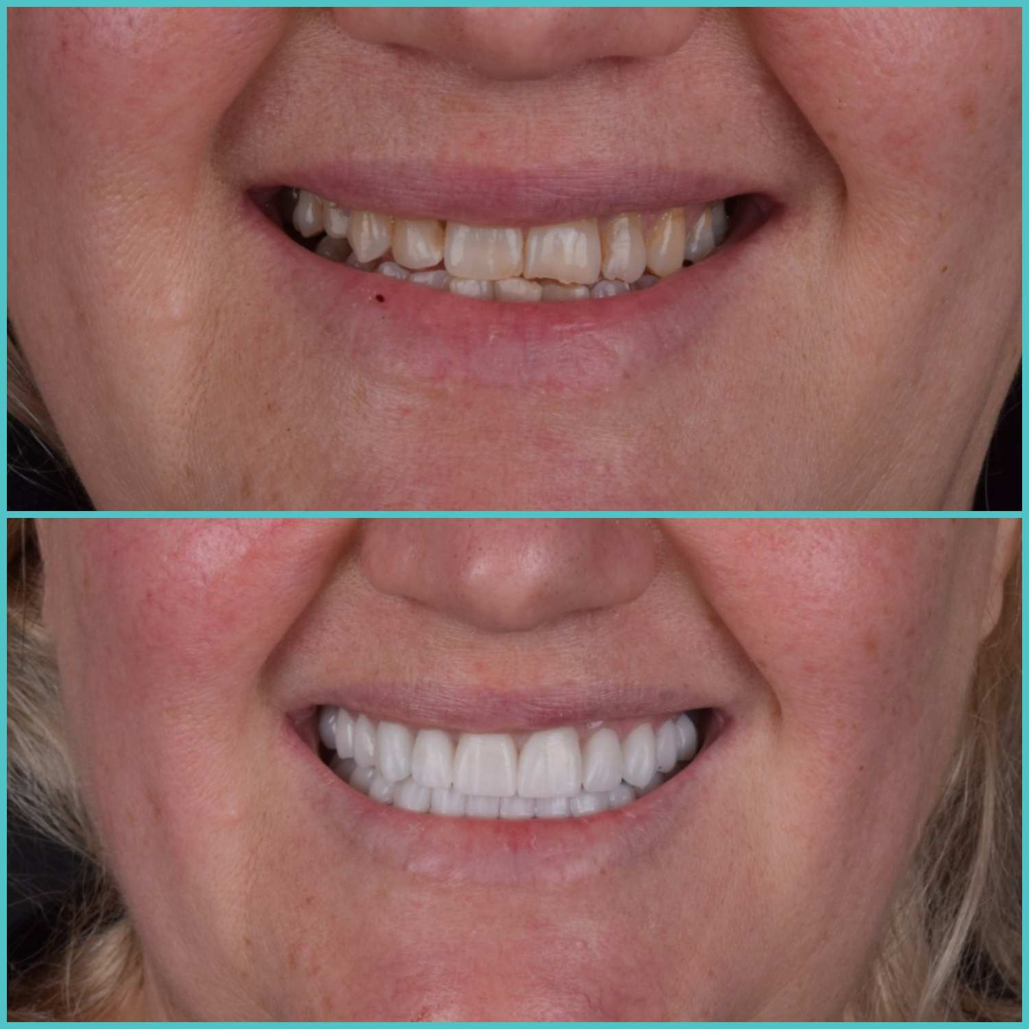 komplette zahnimplantate mit fly2smile