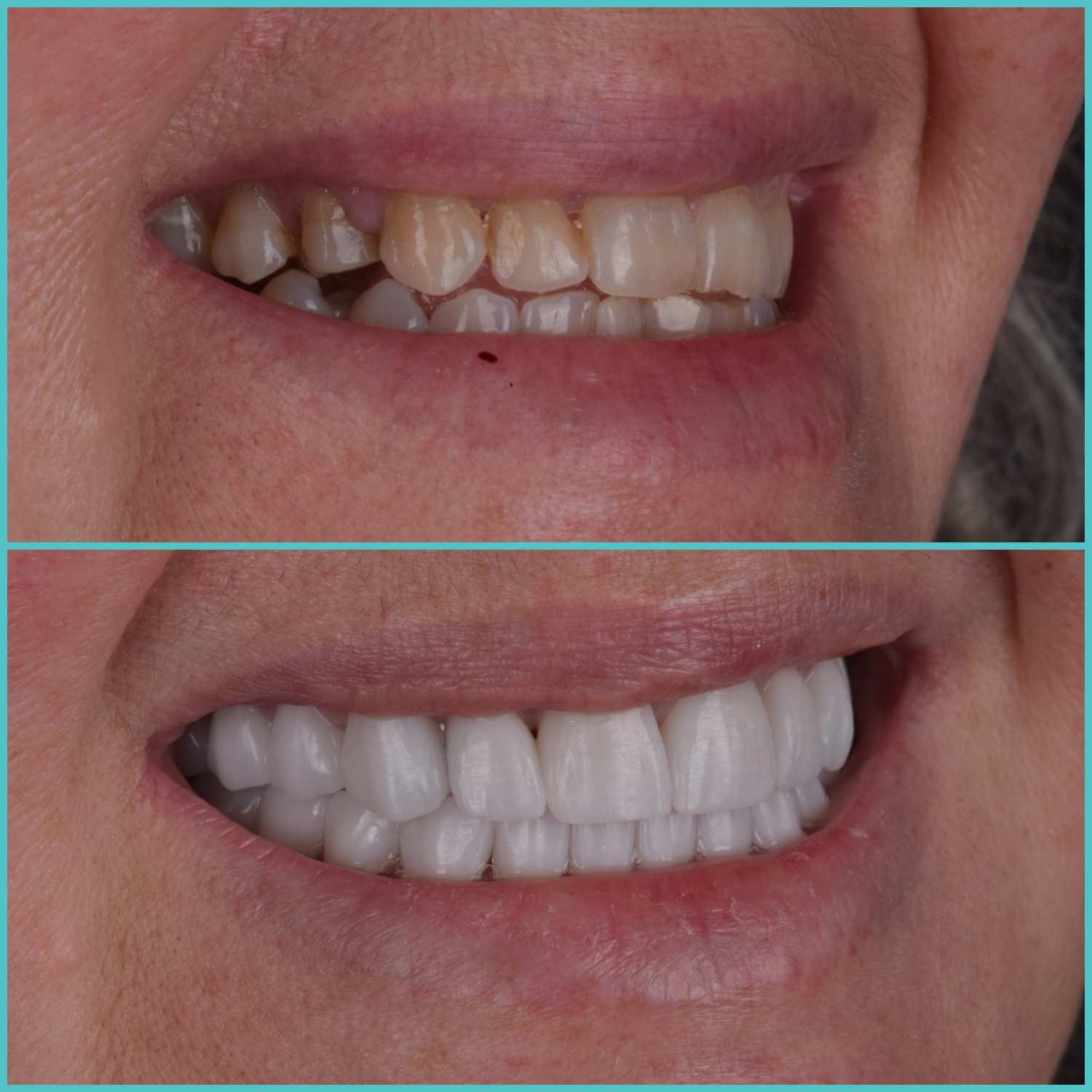 komplette zahnimplantate mit fly2smile