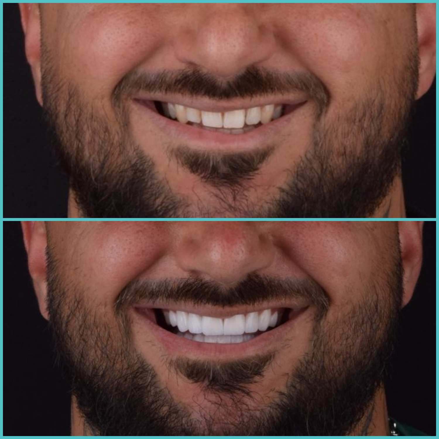 komplette zahnimplantate mit fly2smile