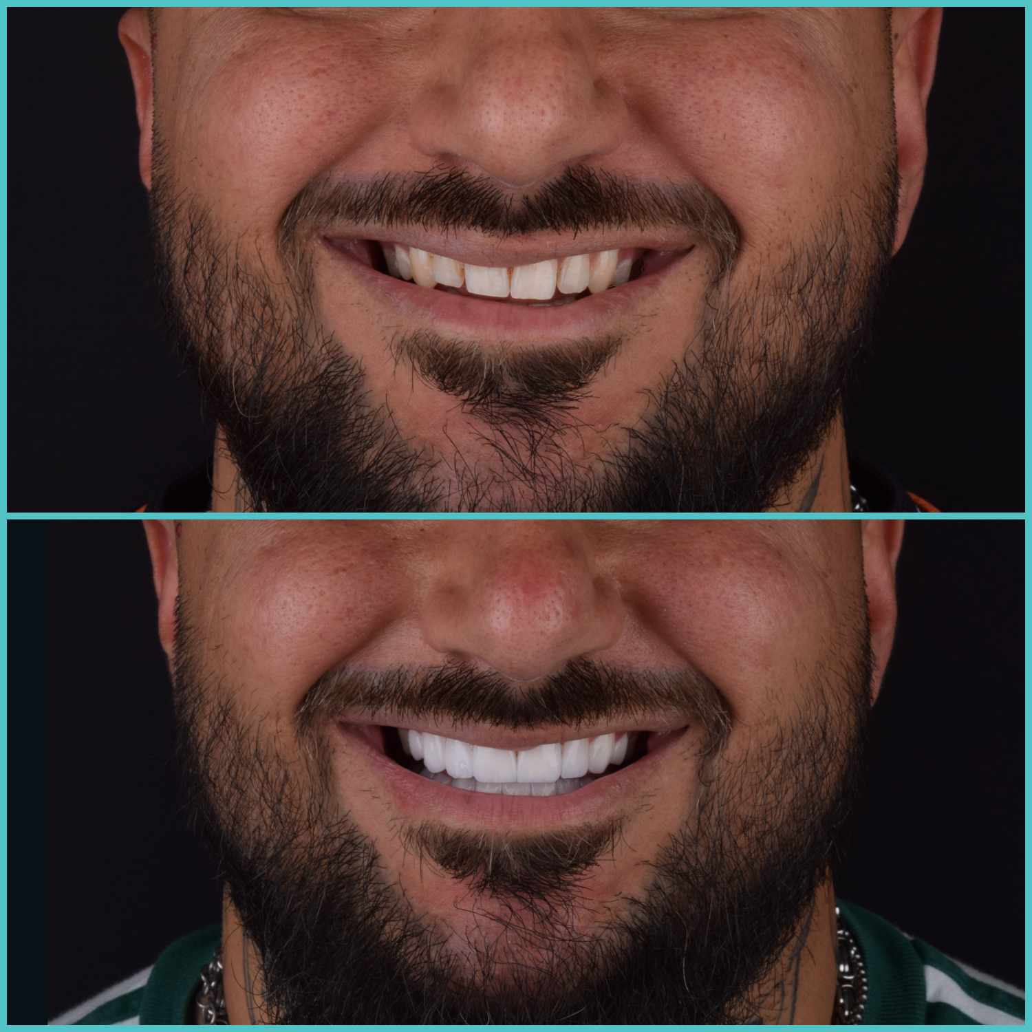 komplette zahnimplantate mit fly2smile