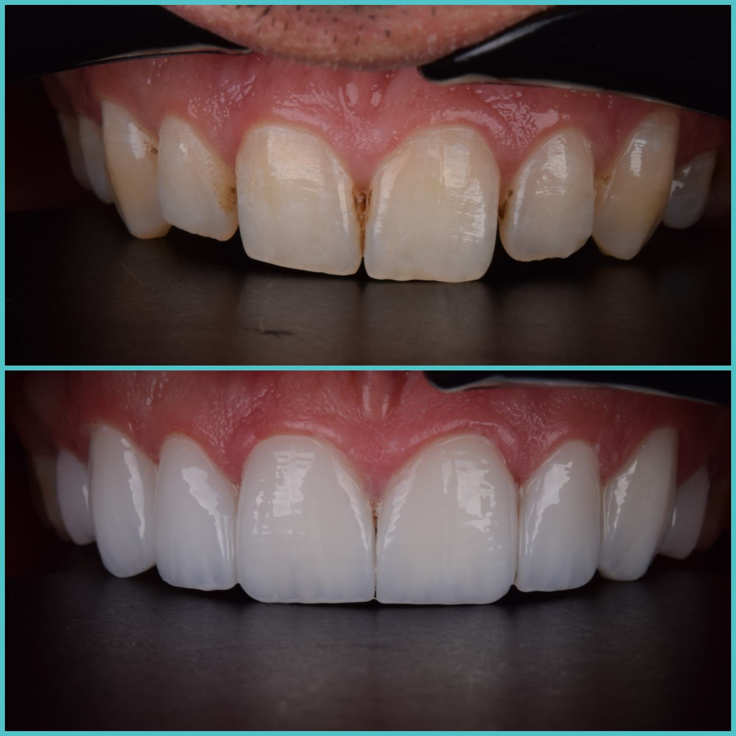 komplette zahnimplantate mit fly2smile