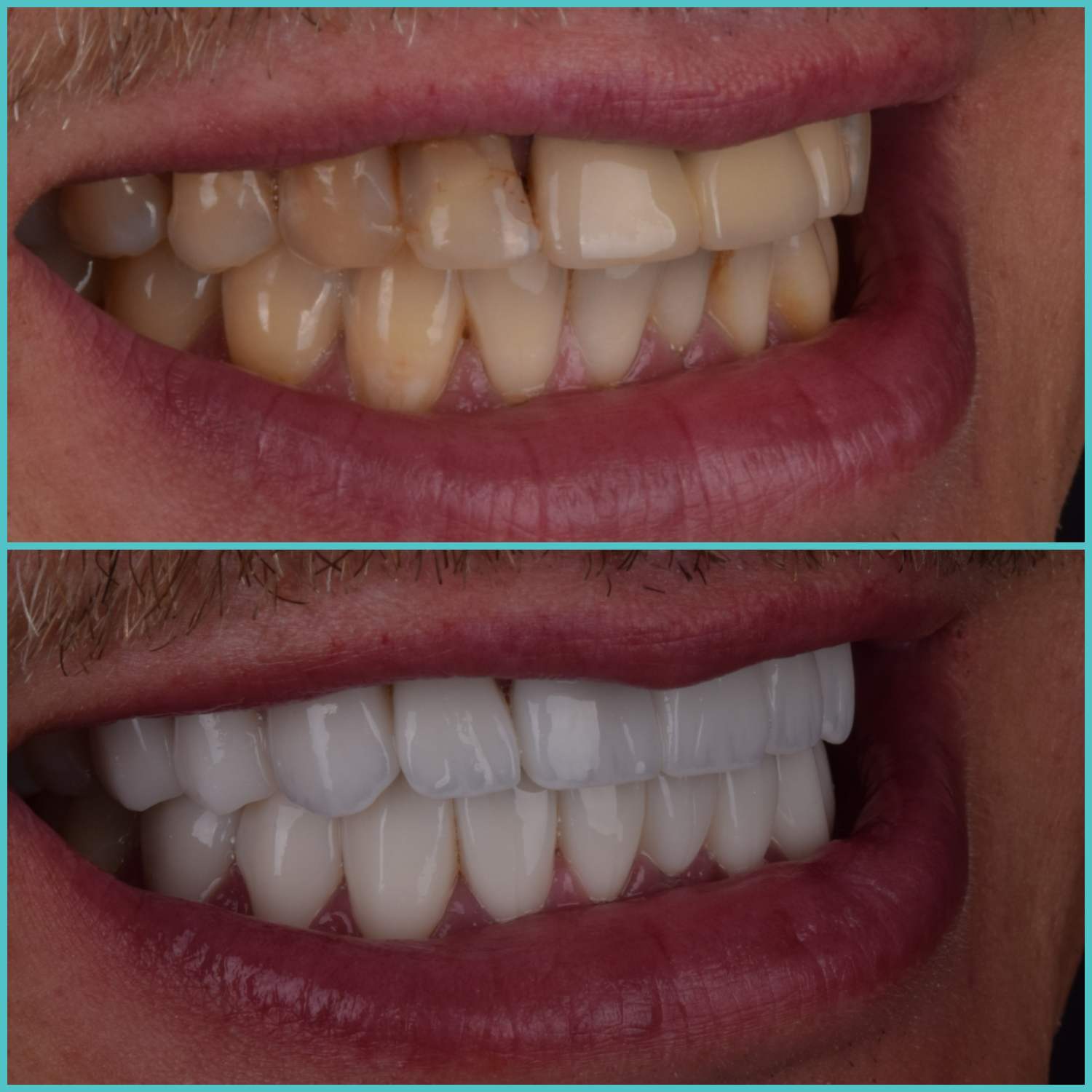 komplette zahnimplantate mit fly2smile