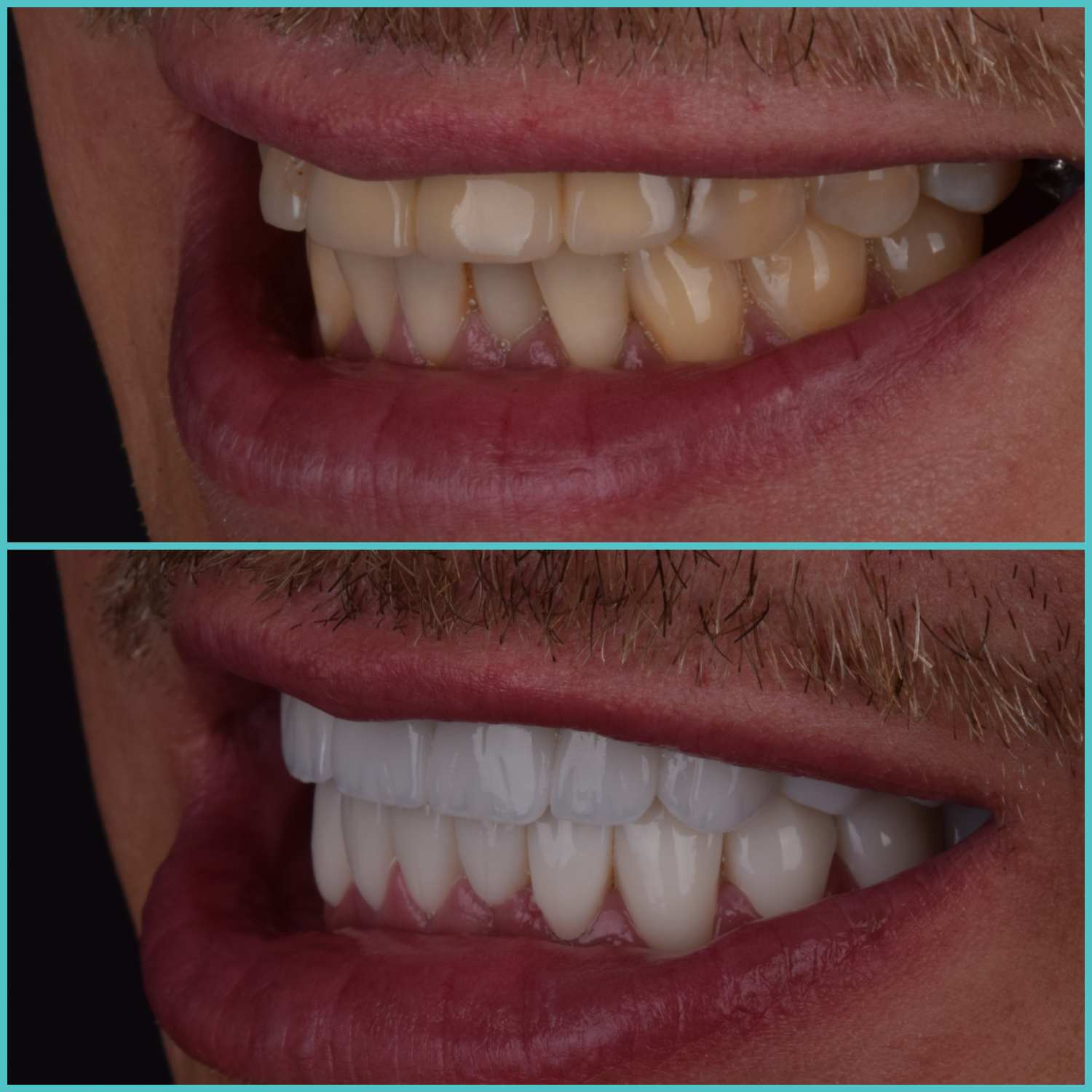 komplette zahnimplantate mit fly2smile