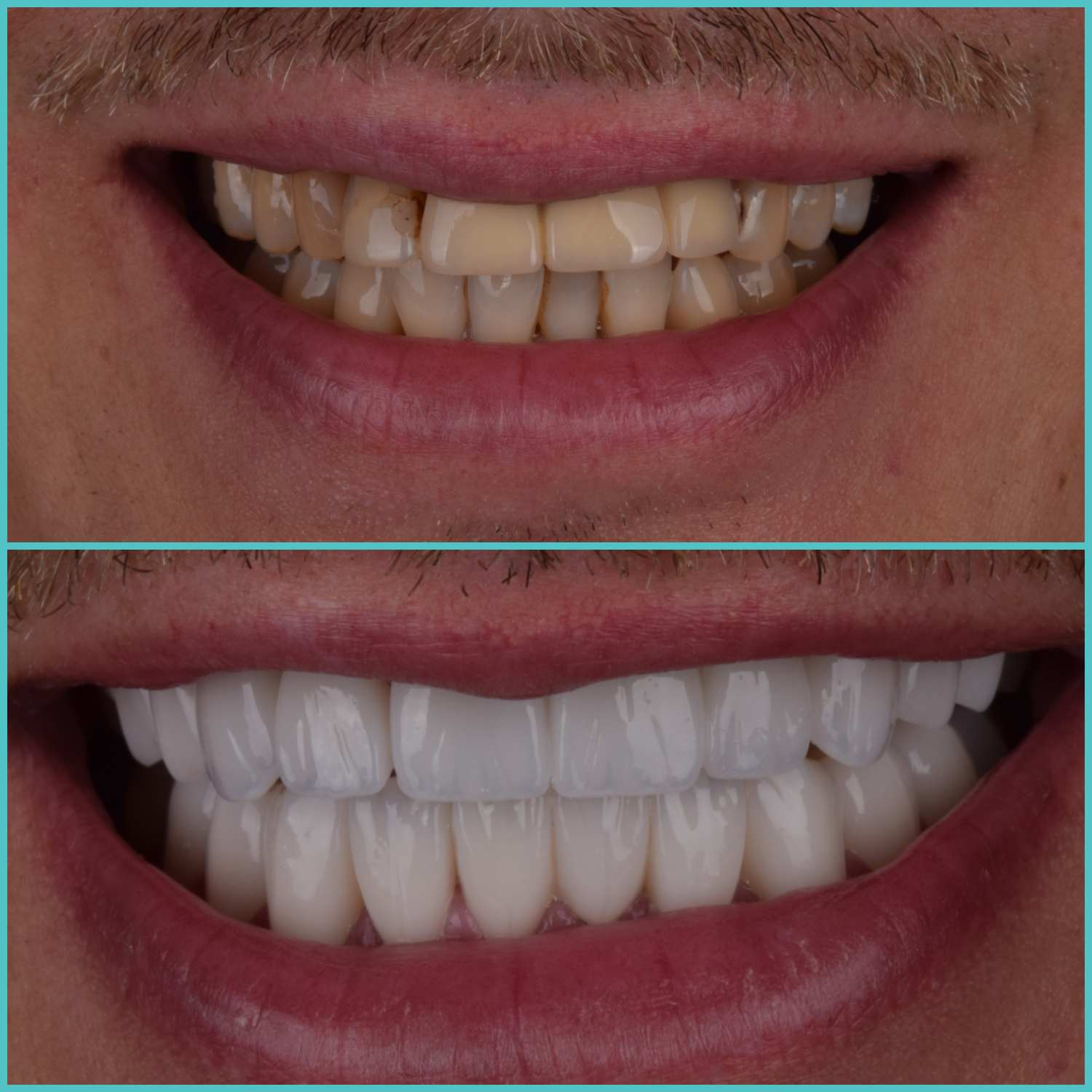 komplette zahnimplantate mit fly2smile