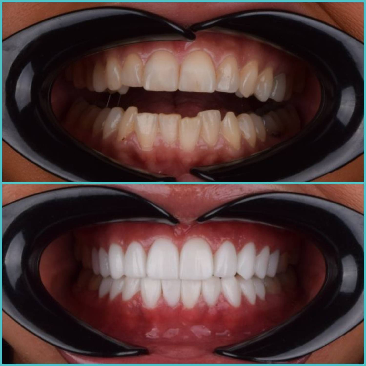 komplette zahnimplantate mit fly2smile