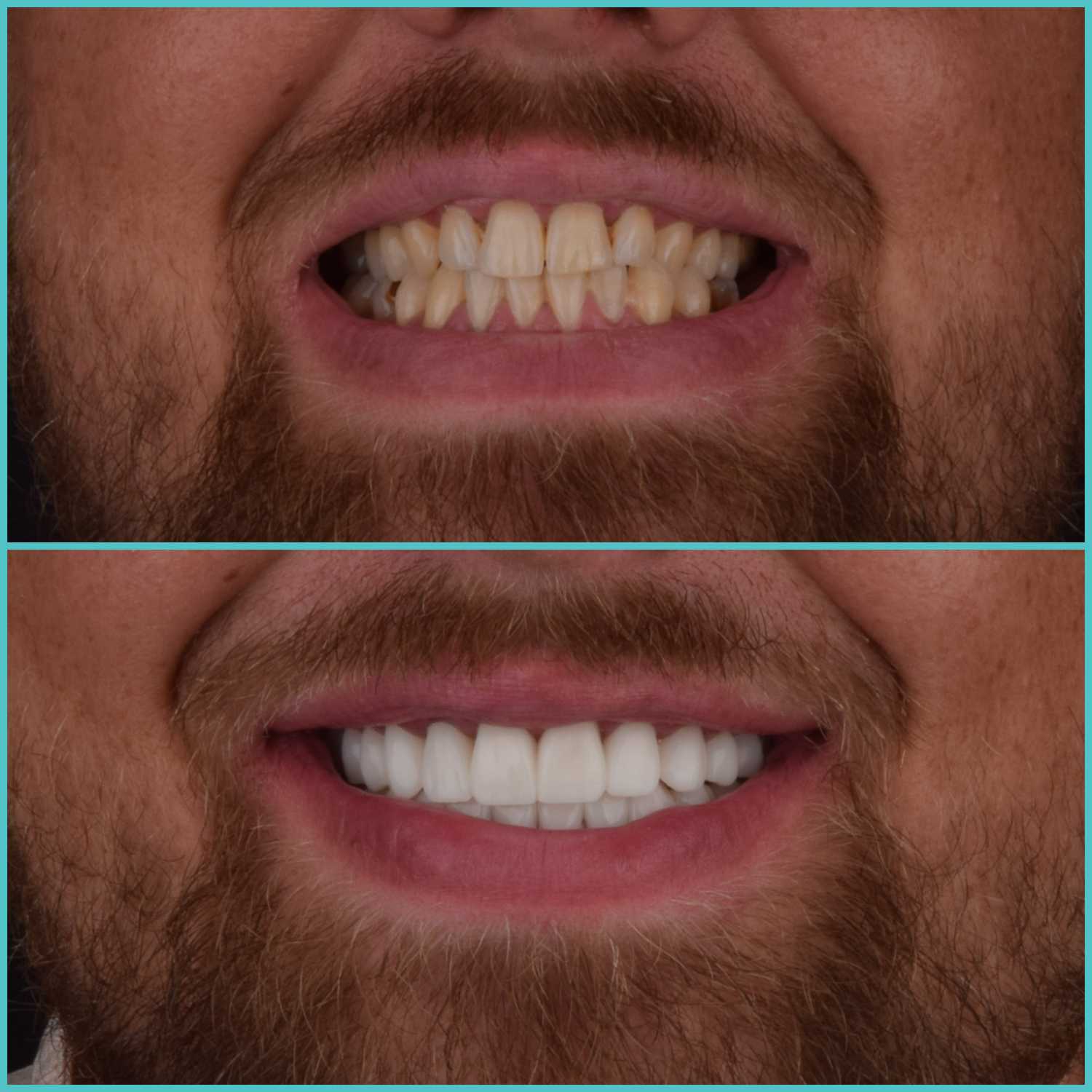 komplette zahnimplantate mit fly2smile