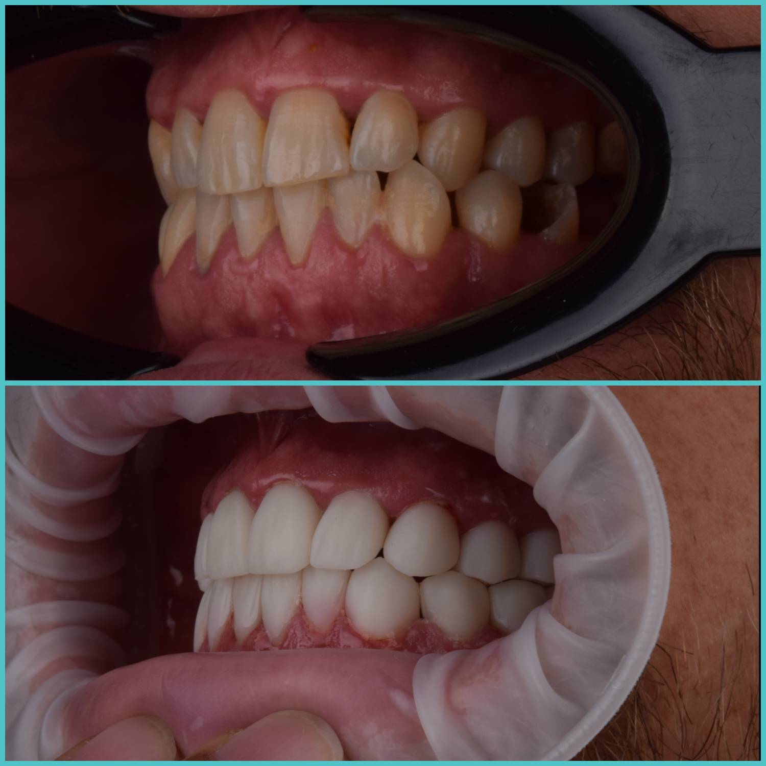 komplette zahnimplantate mit fly2smile